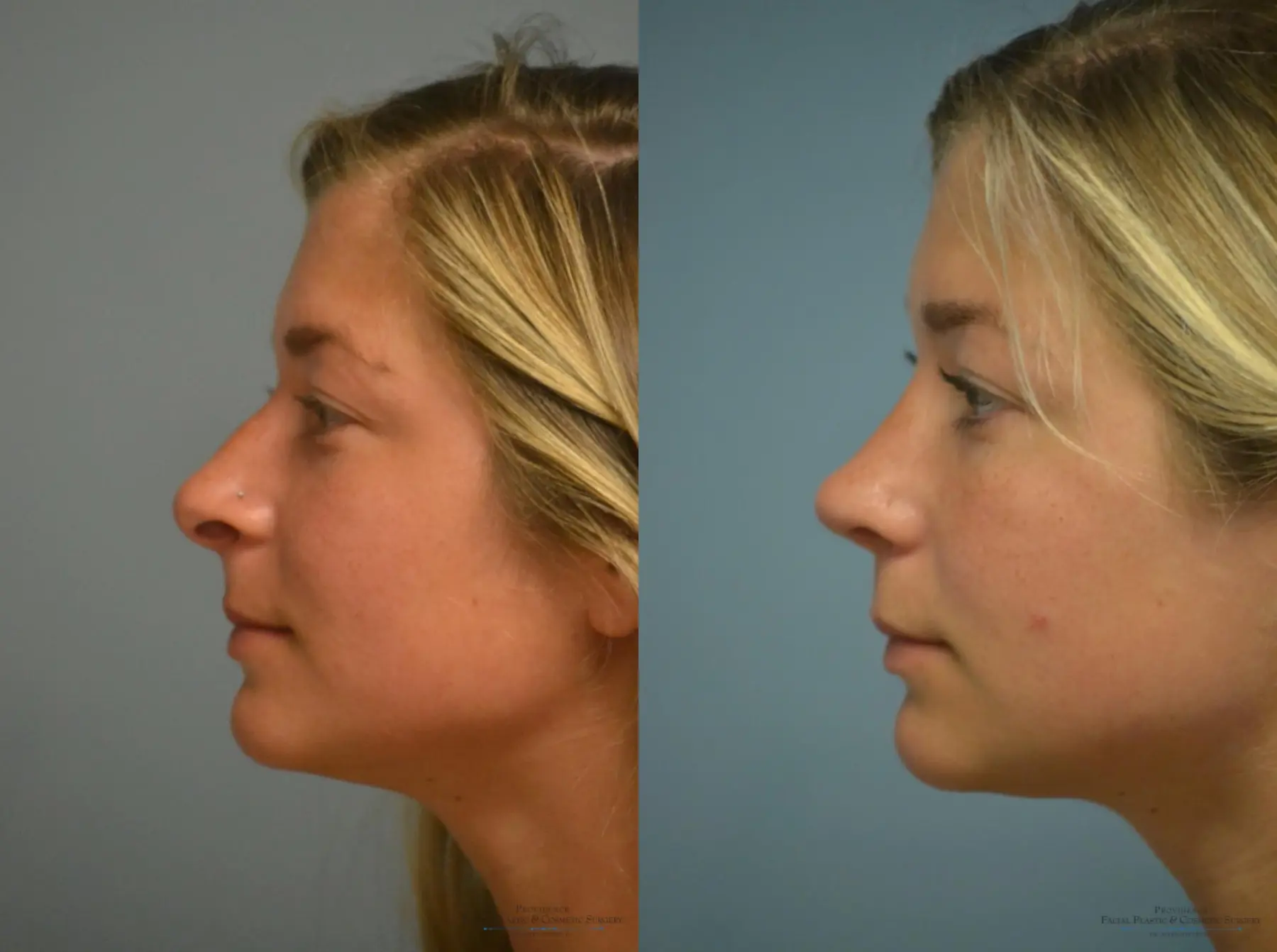 Rhinoplasty: Patient 5 - Before and After 3