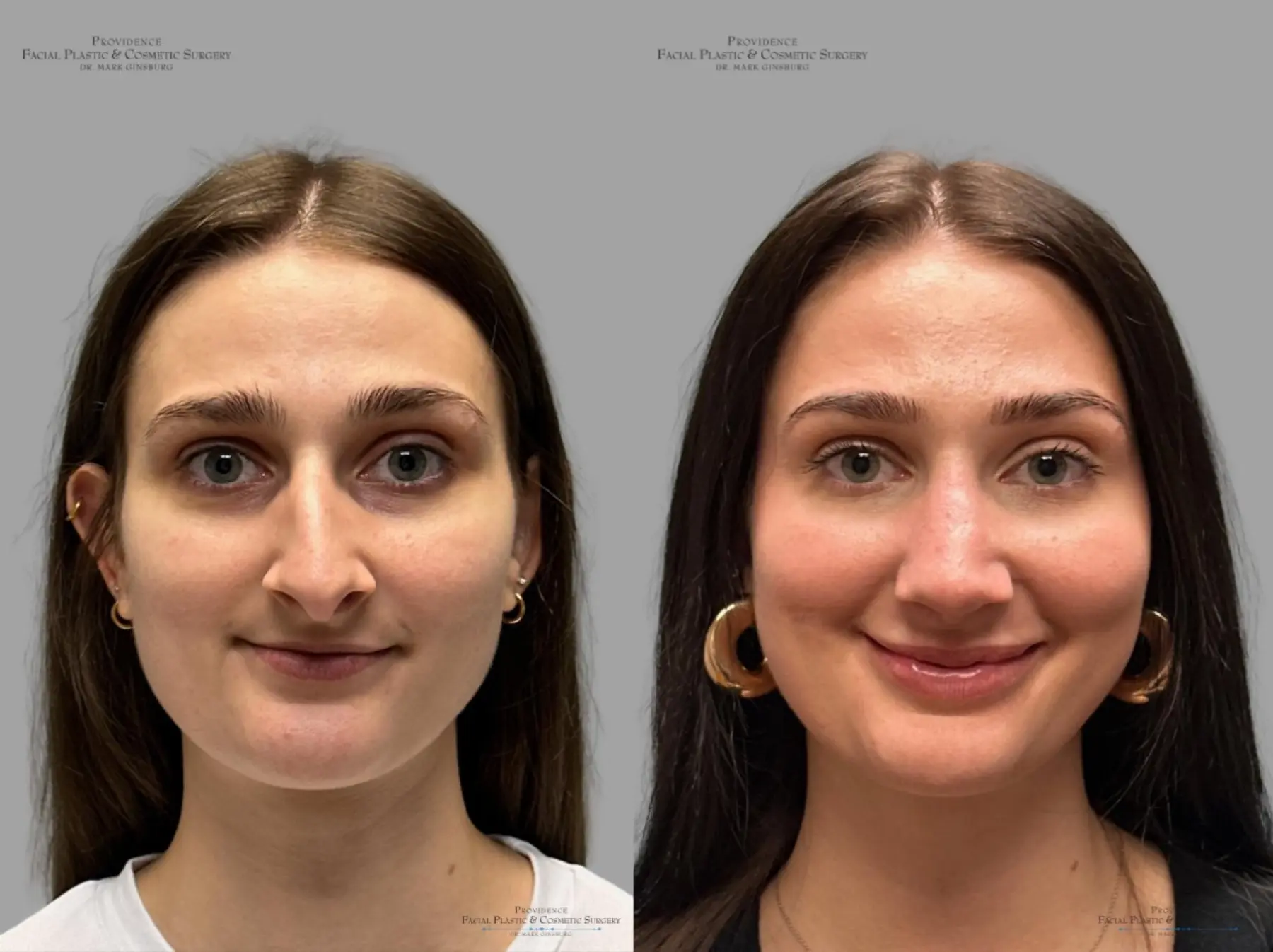 Rhinoplasty: Patient 32 - Before and After 1