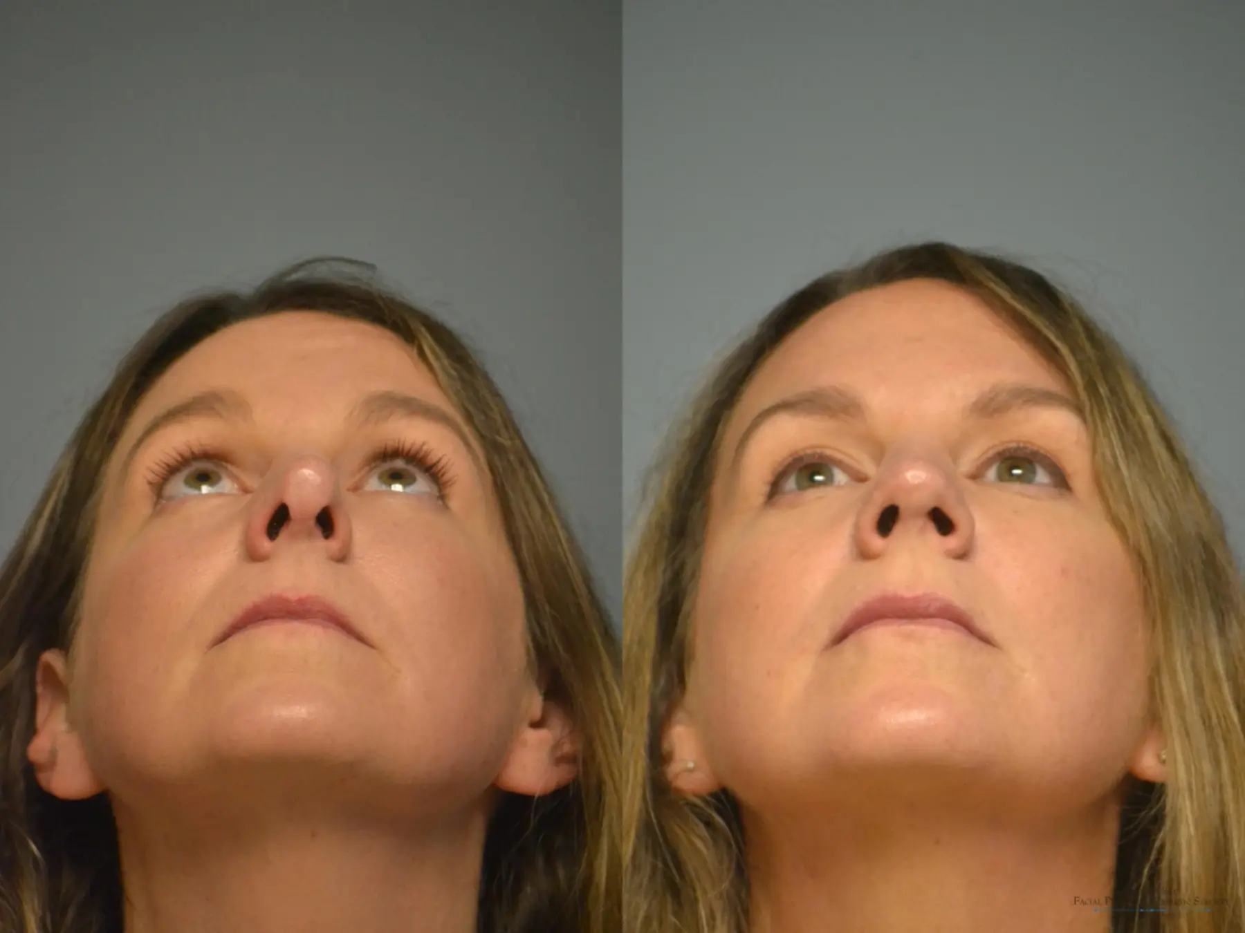 Rhinoplasty: Patient 13 - Before and After 5