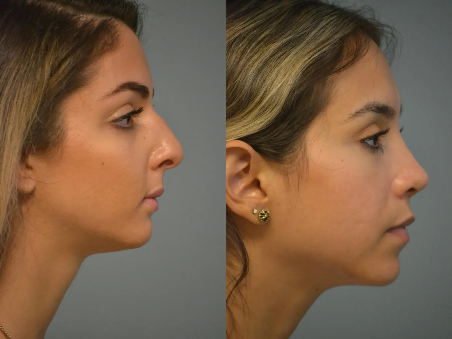 Rhinoplasty: Patient 24 - Before and After 4