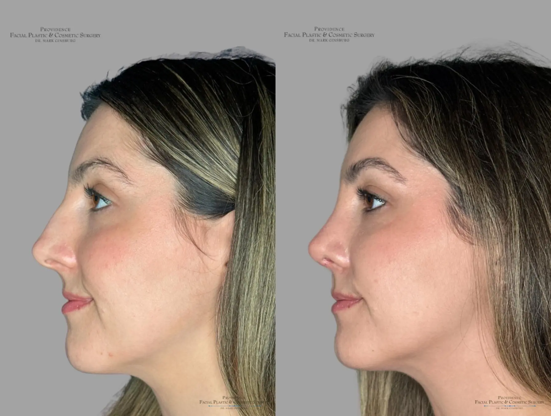 Rhinoplasty: Patient 40 - Before and After 5