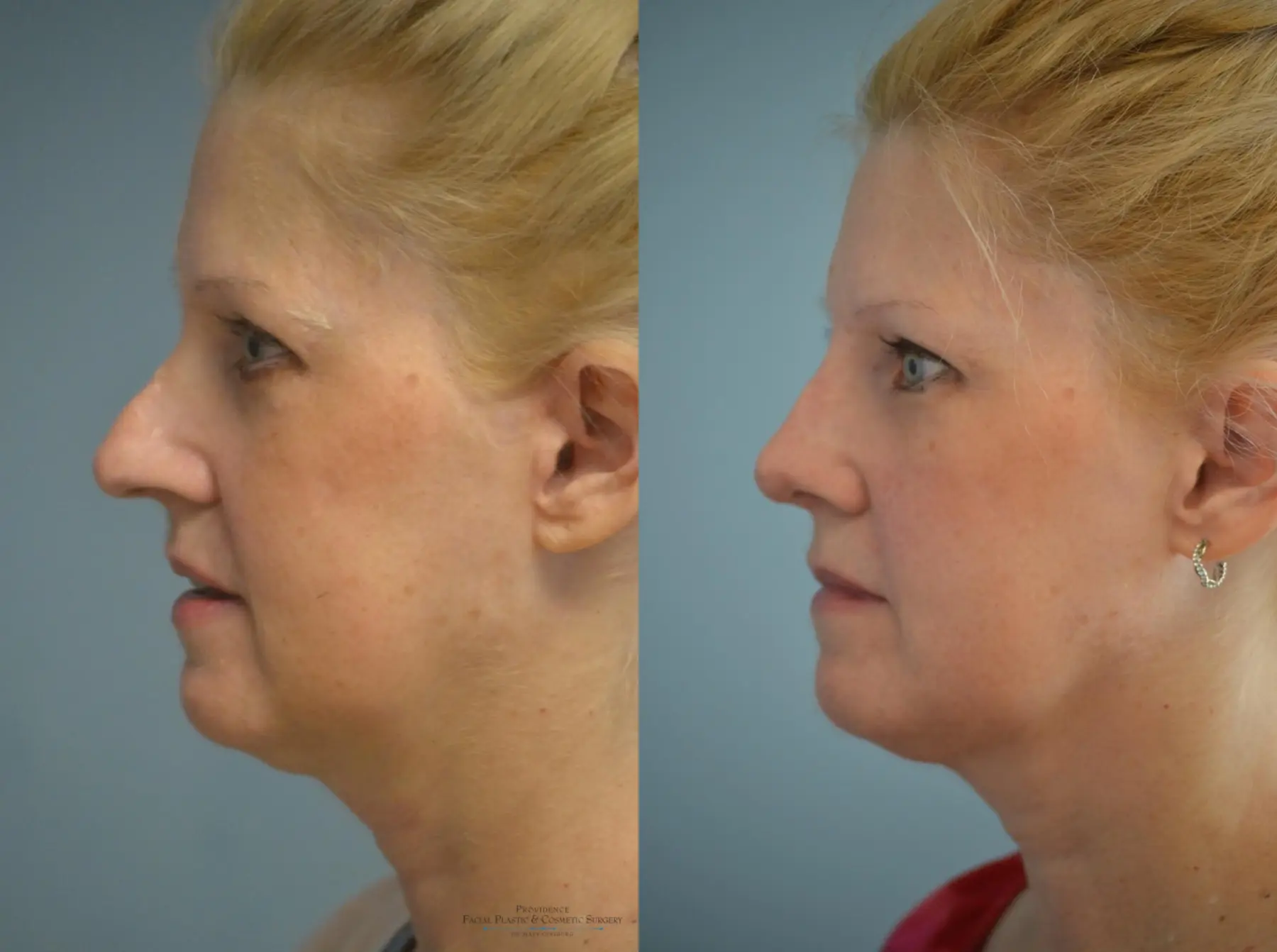 Rhinoplasty: Patient 7 - Before and After 3