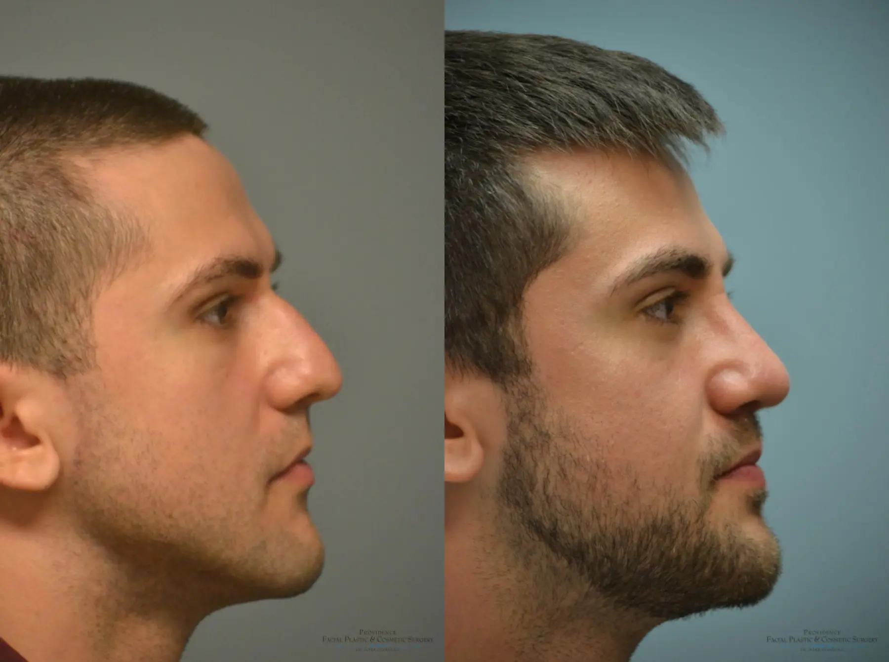 Rhinoplasty: Patient 2 - Before and After 4