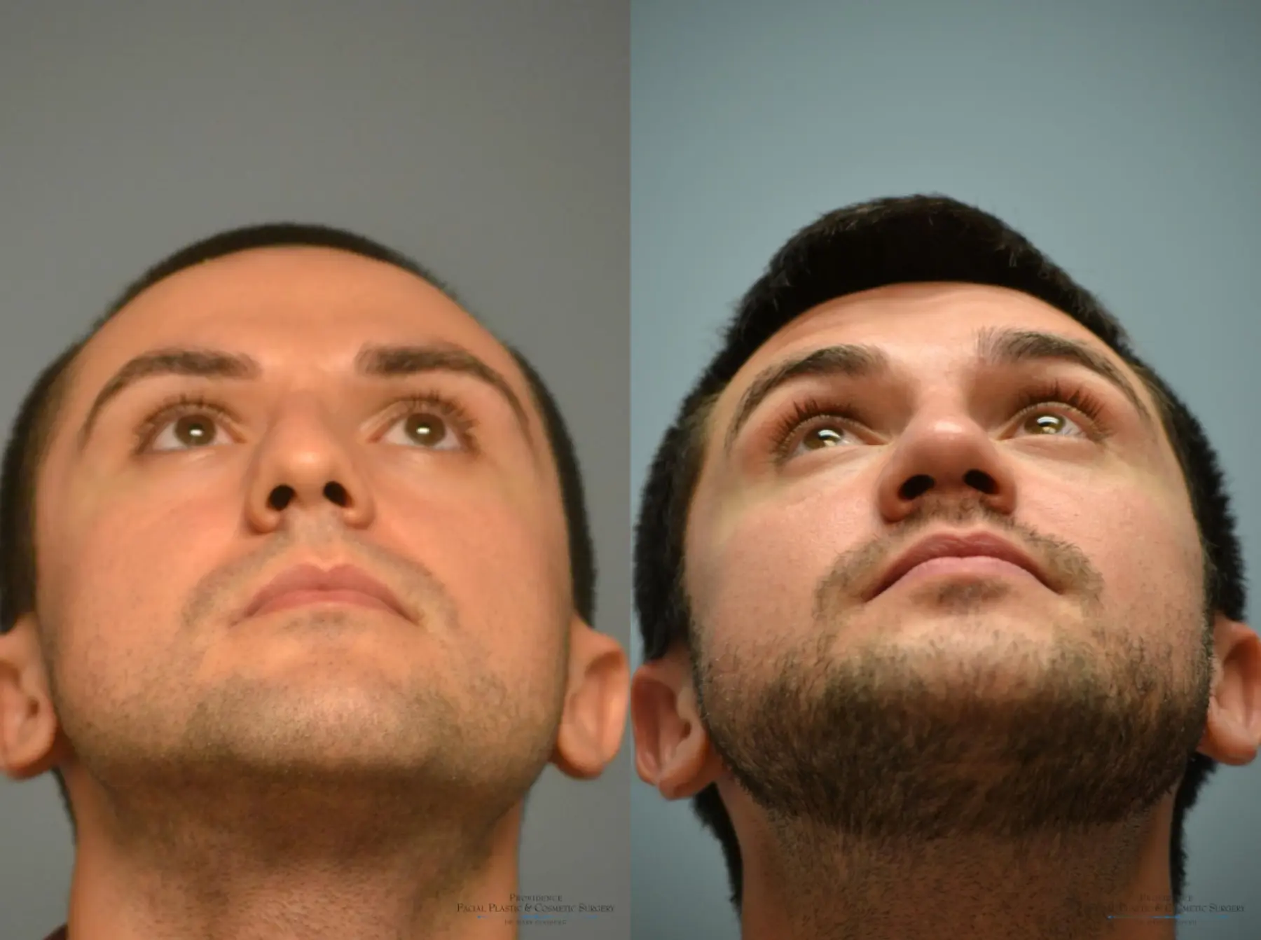 Rhinoplasty: Patient 2 - Before and After 5