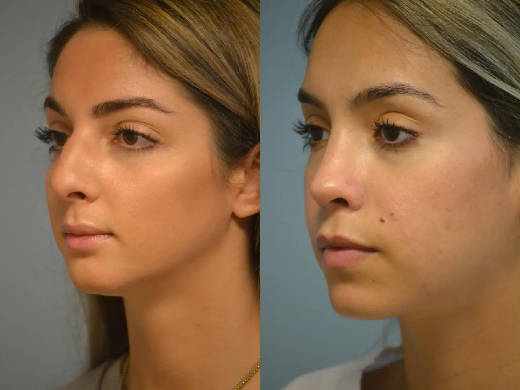 Rhinoplasty: Patient 24 - Before and After 2