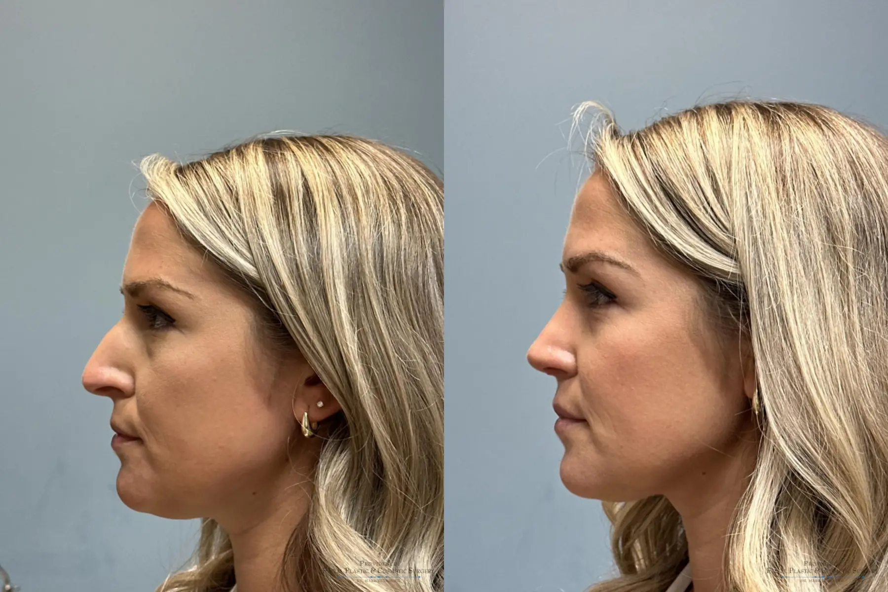 Rhinoplasty: Patient 28 - Before and After 1