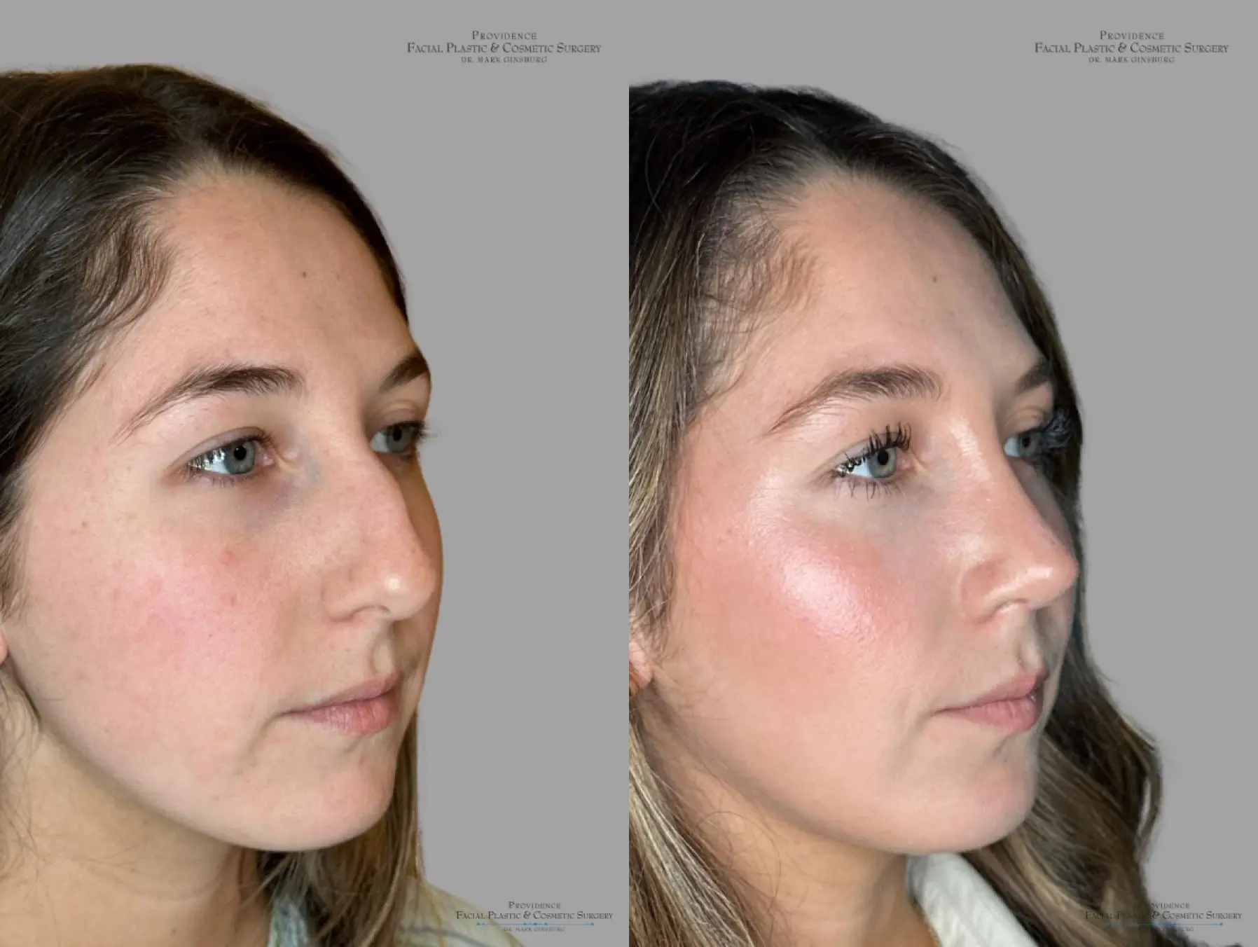 Rhinoplasty: Patient 36 - Before and After 2