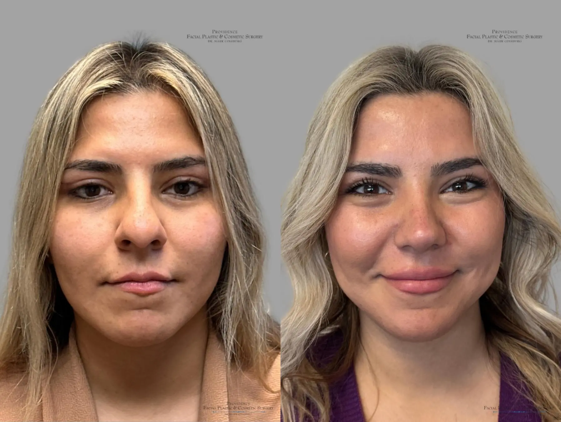 Rhinoplasty: Patient 35 - Before and After 1