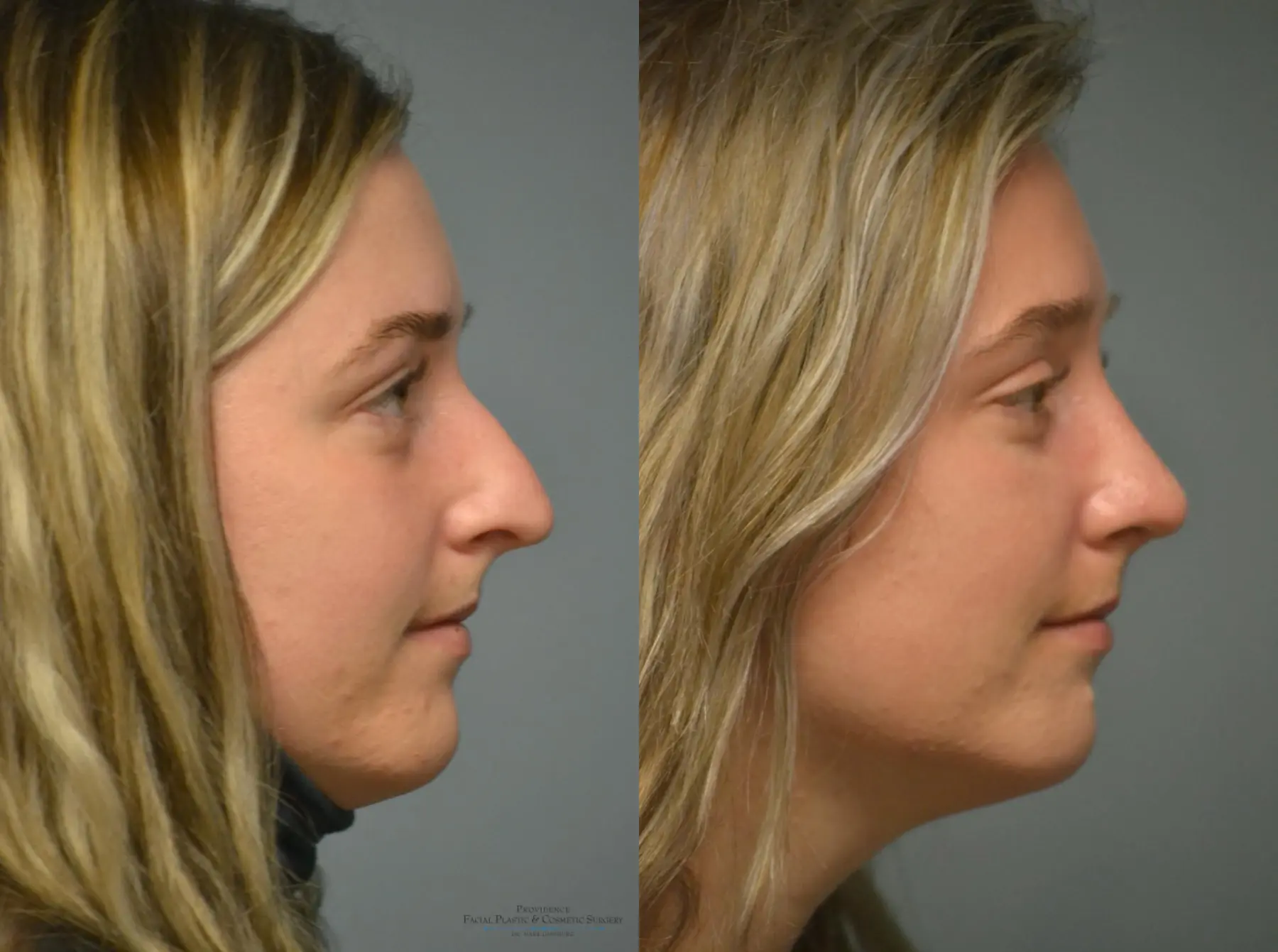 Rhinoplasty: Patient 9 - Before and After 4