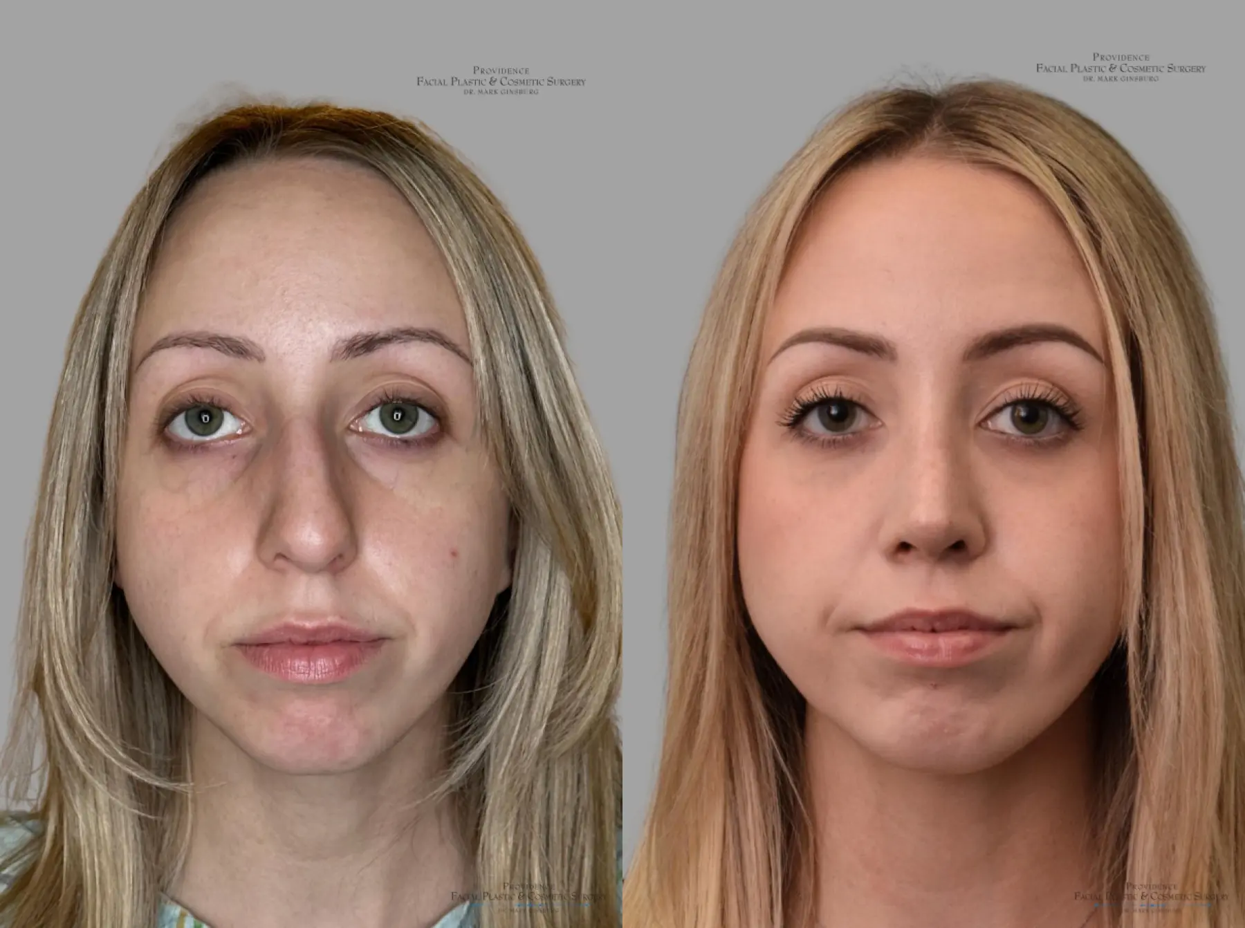 Rhinoplasty: Patient 42 - Before and After 1