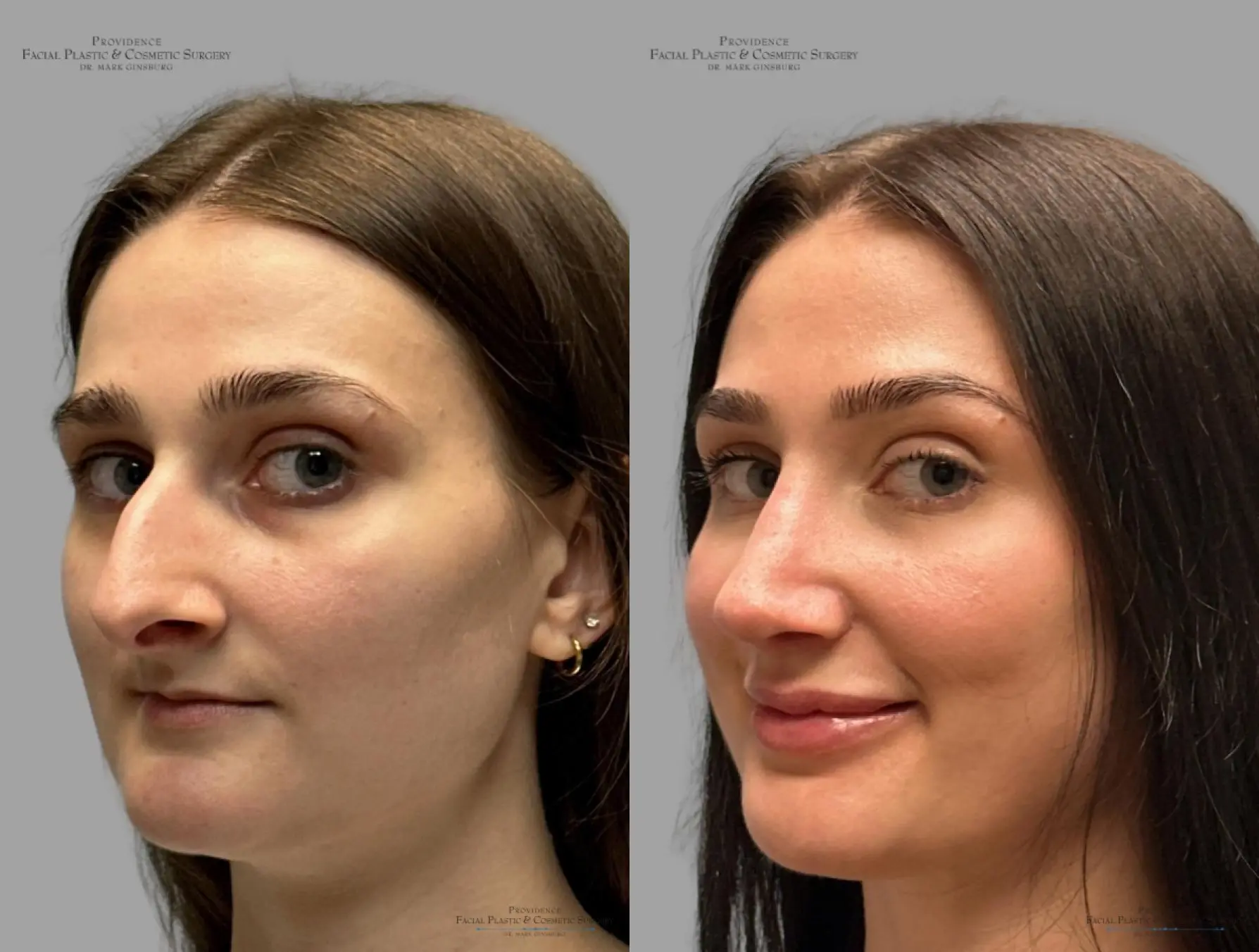 Rhinoplasty: Patient 32 - Before and After 4