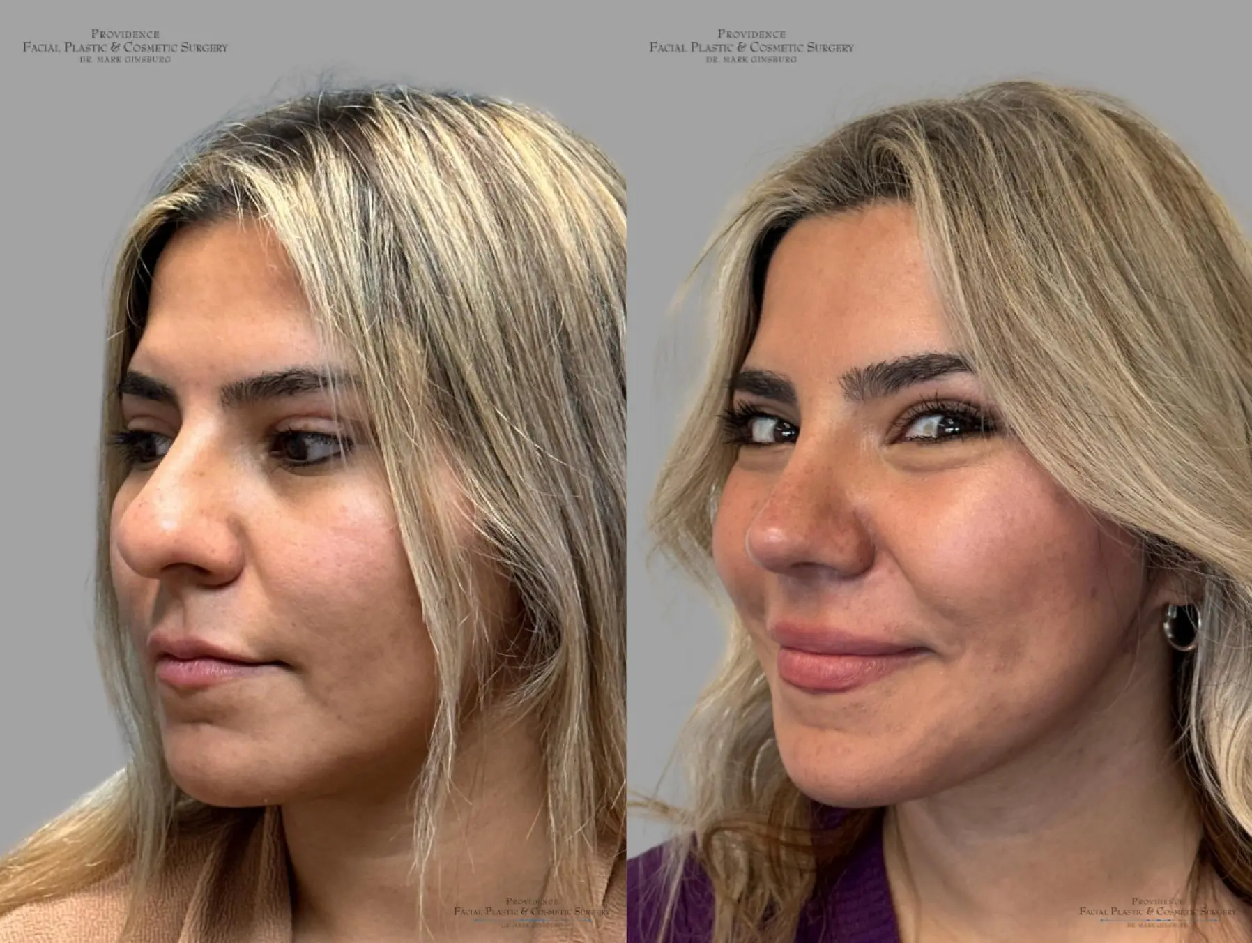 Rhinoplasty: Patient 35 - Before and After 5
