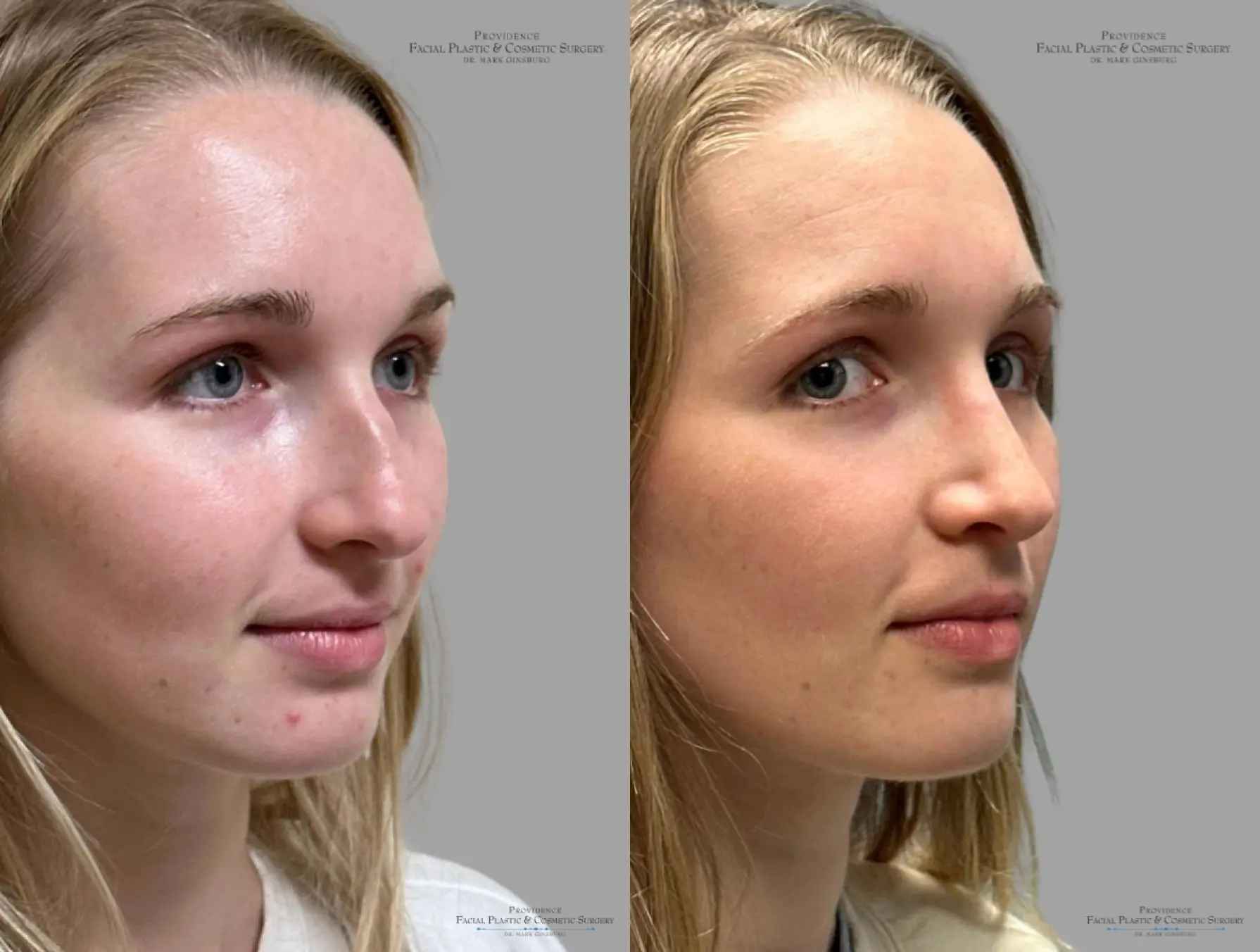 Rhinoplasty: Patient 39 - Before and After 2