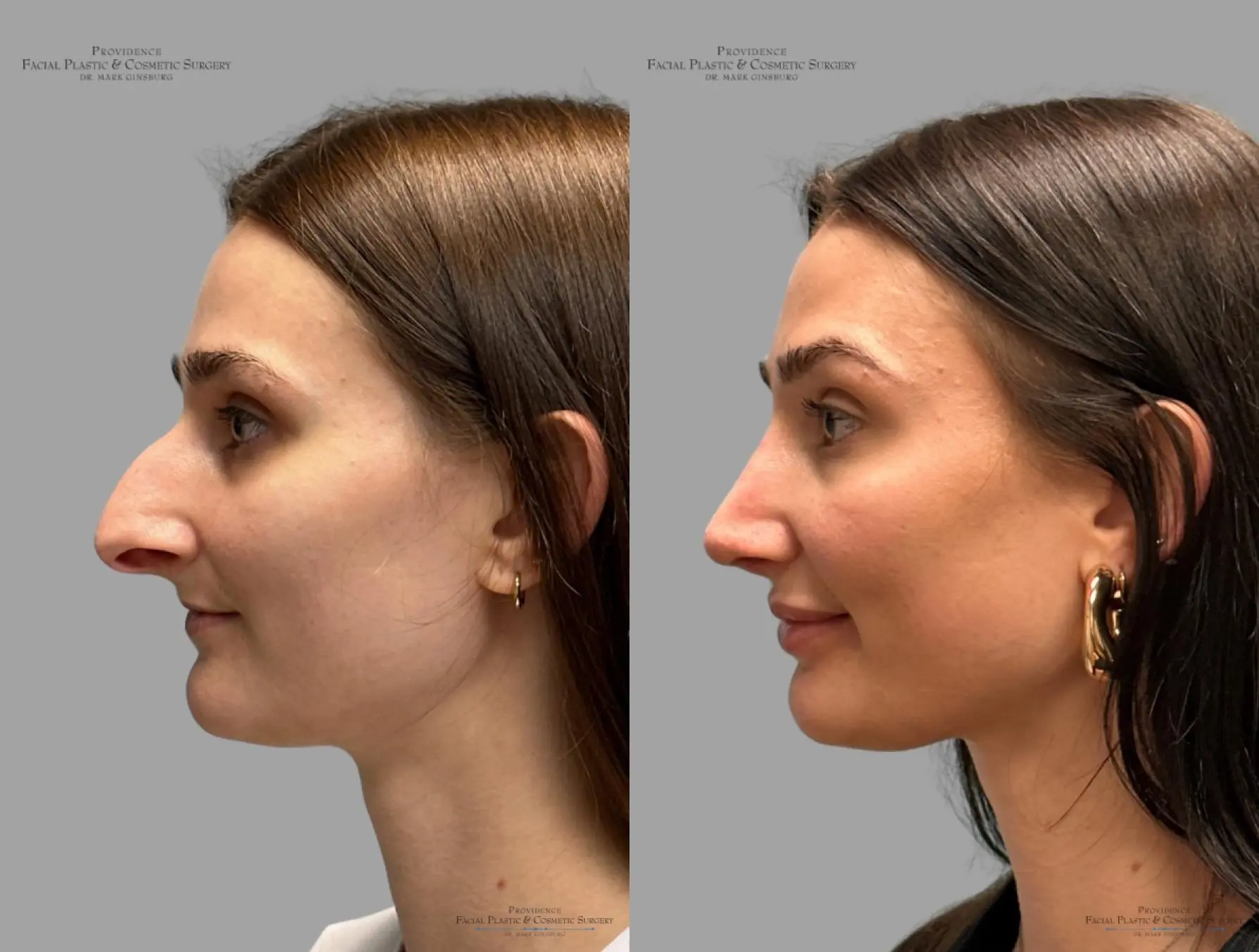 Rhinoplasty: Patient 32 - Before and After 5