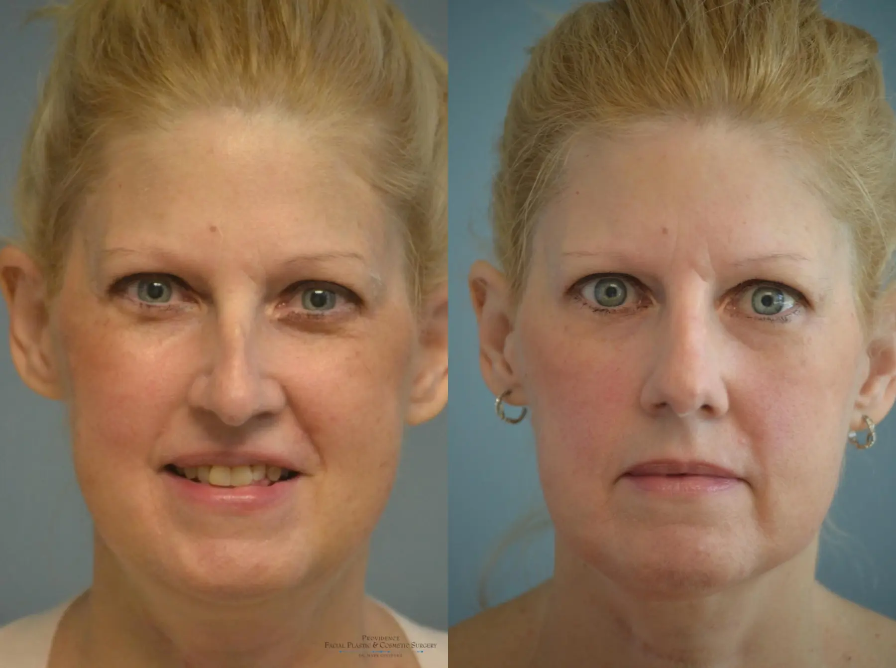 Rhinoplasty: Patient 7 - Before and After  