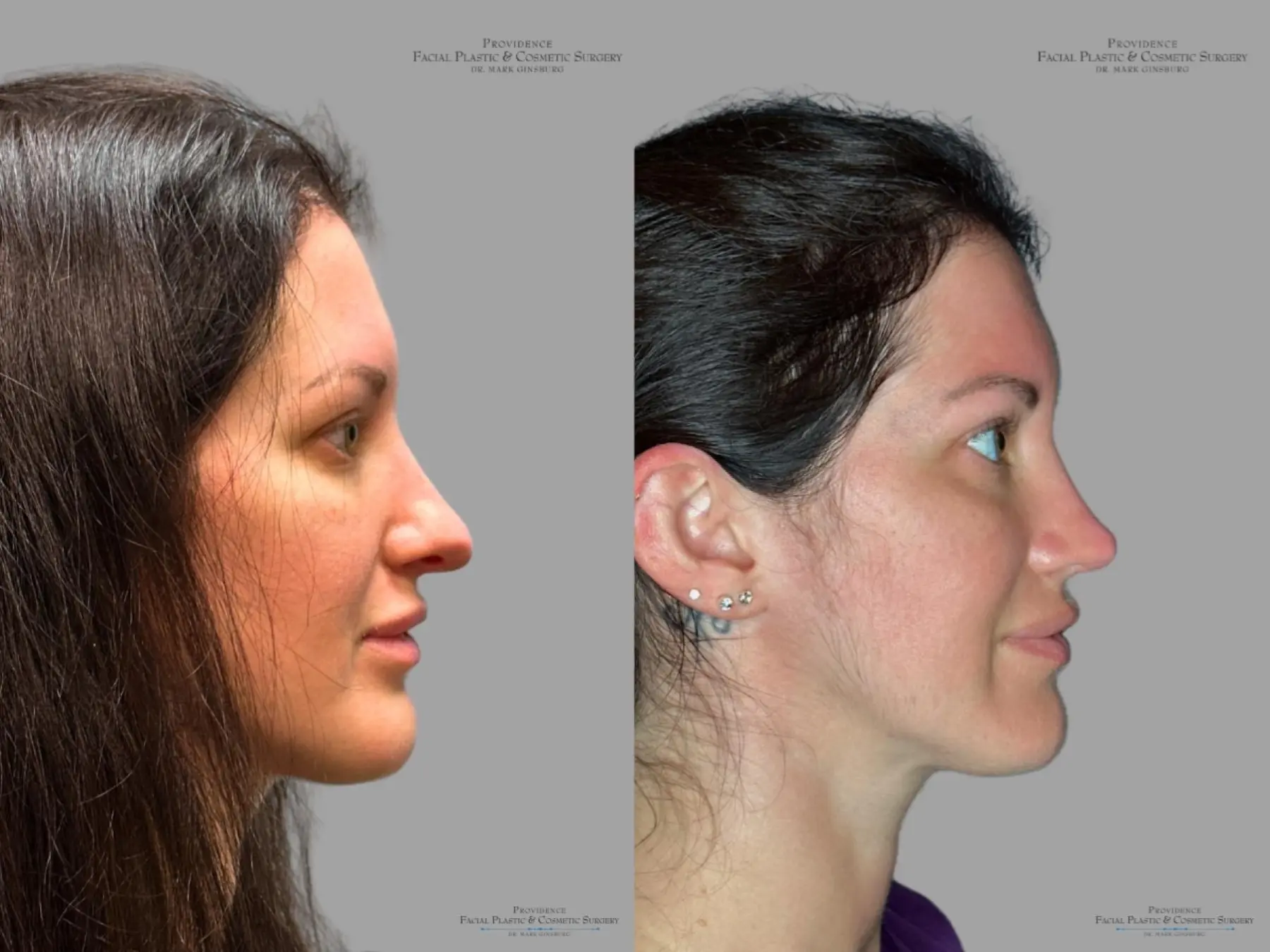 Rhinoplasty: Patient 33 - Before and After 4