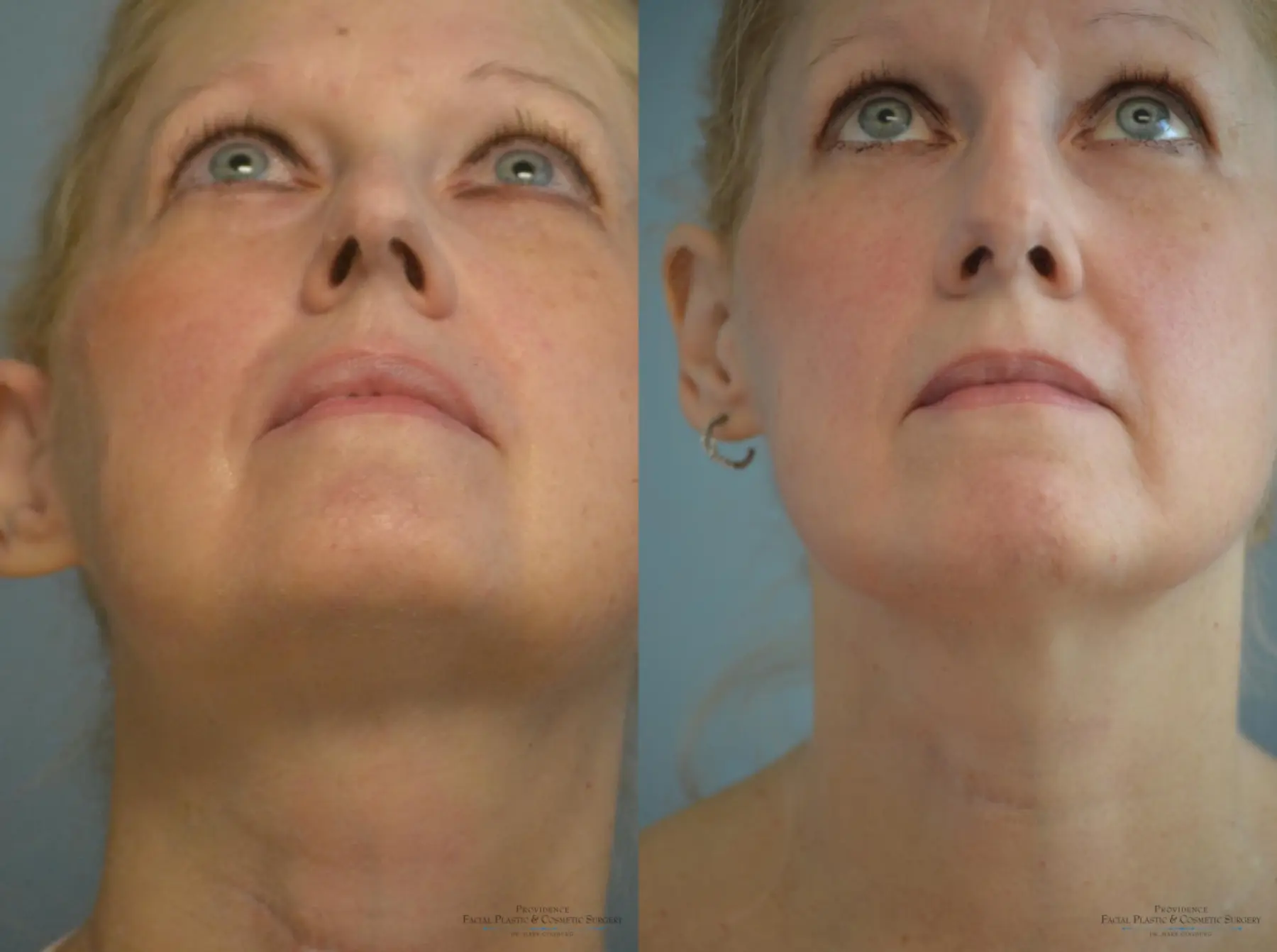 Rhinoplasty: Patient 7 - Before and After 5