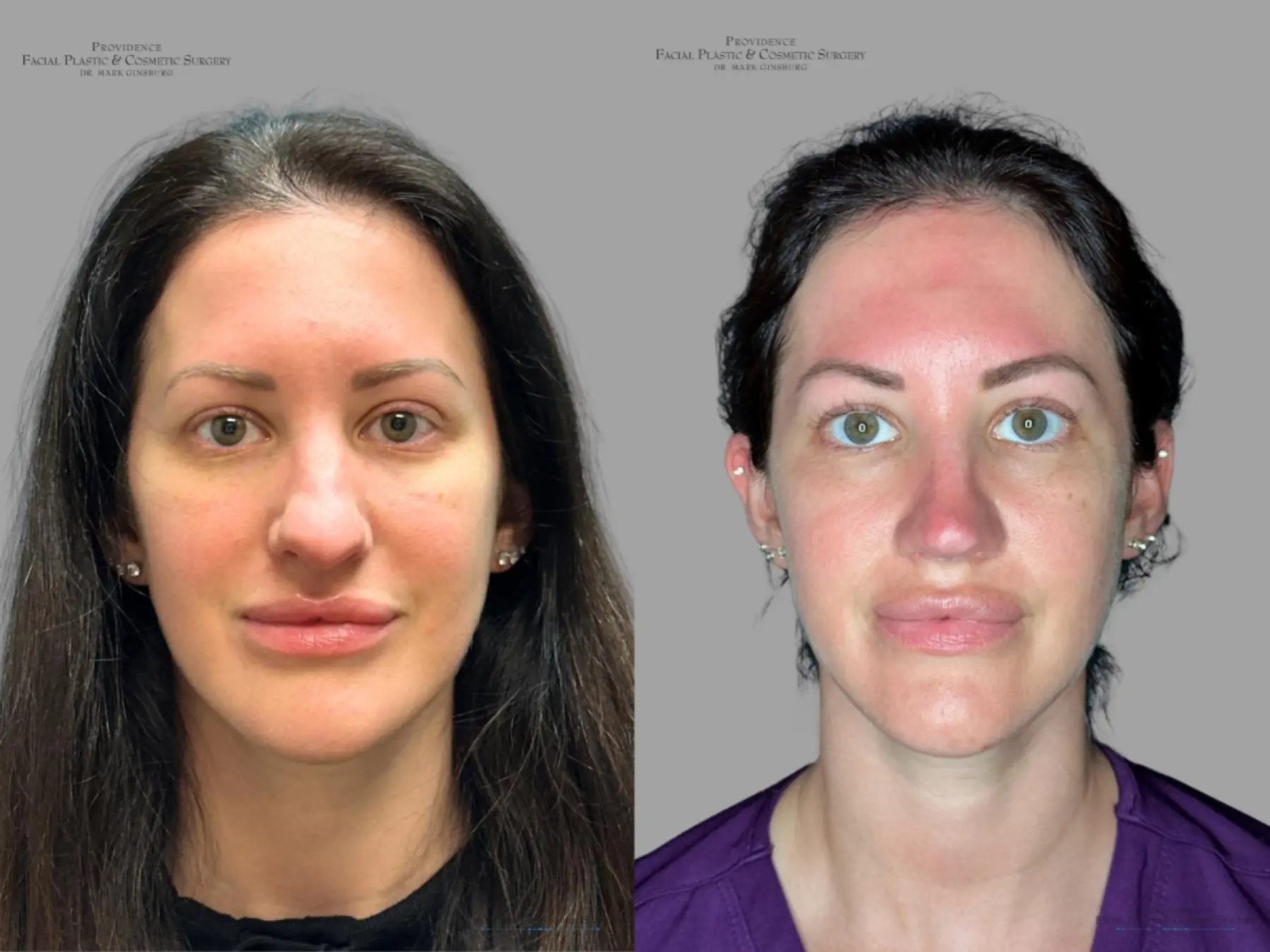 Rhinoplasty: Patient 33 - Before and After 1