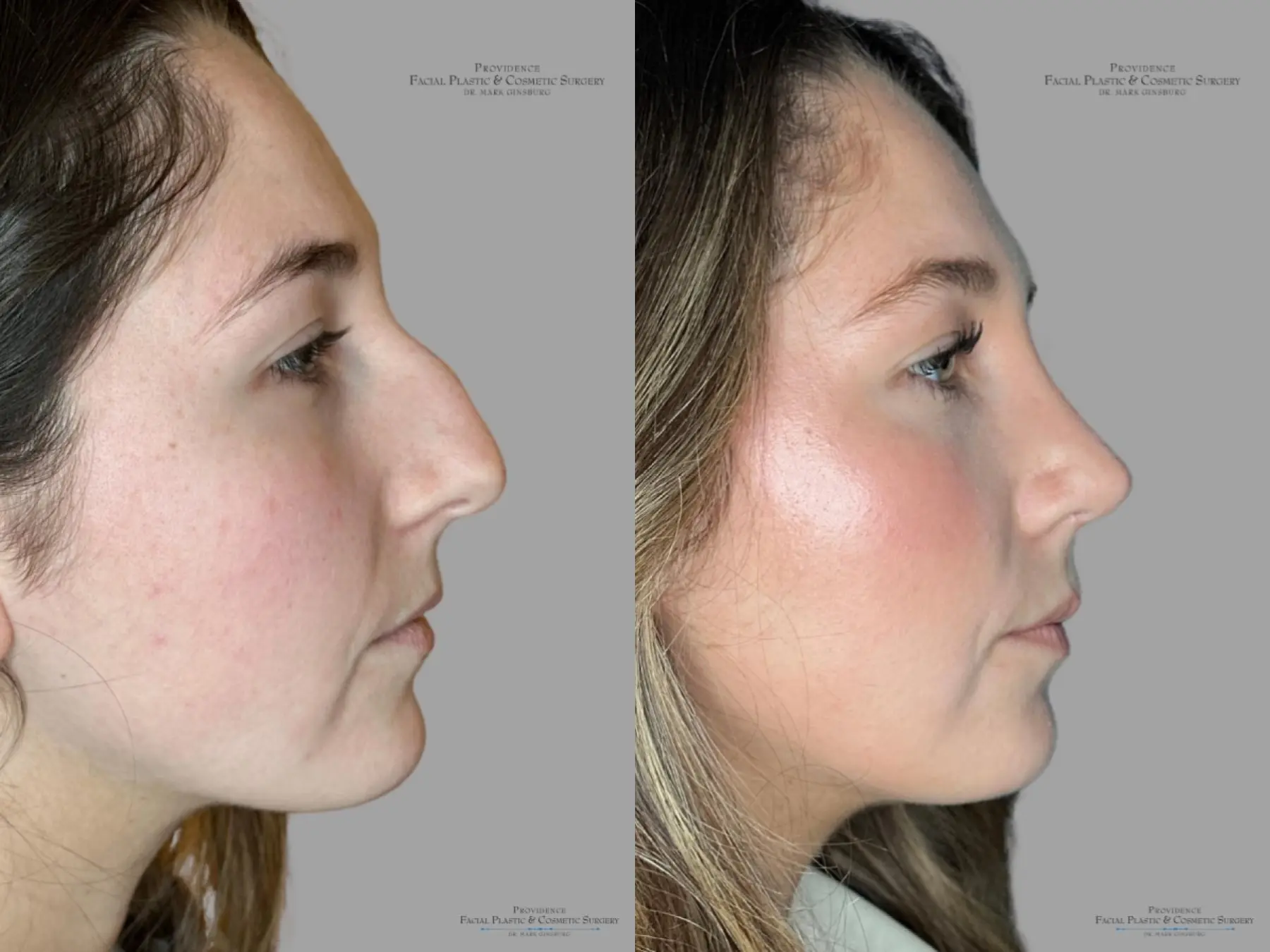 Rhinoplasty: Patient 36 - Before and After 3