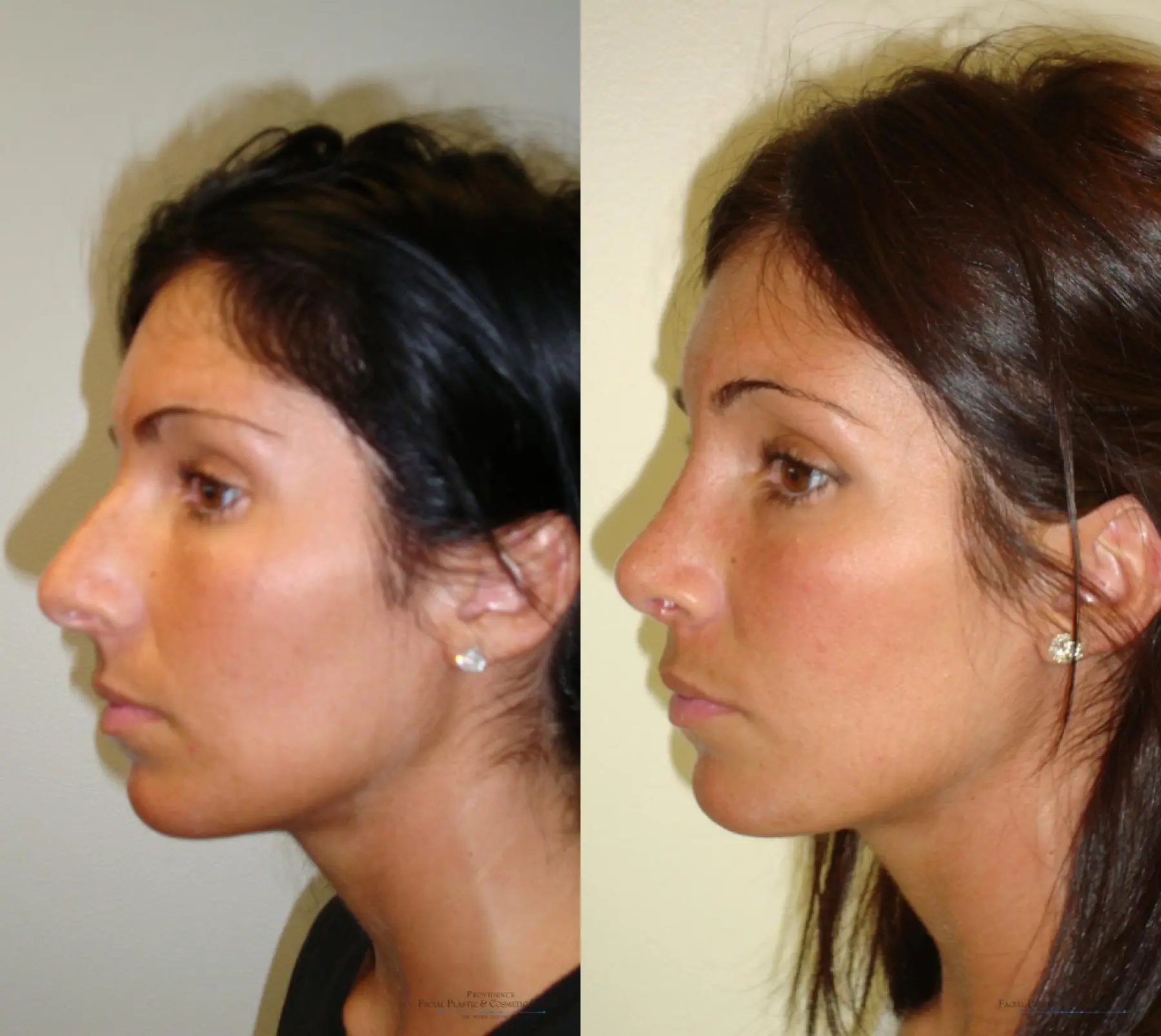 Rhinoplasty: Patient 11 - Before and After 5