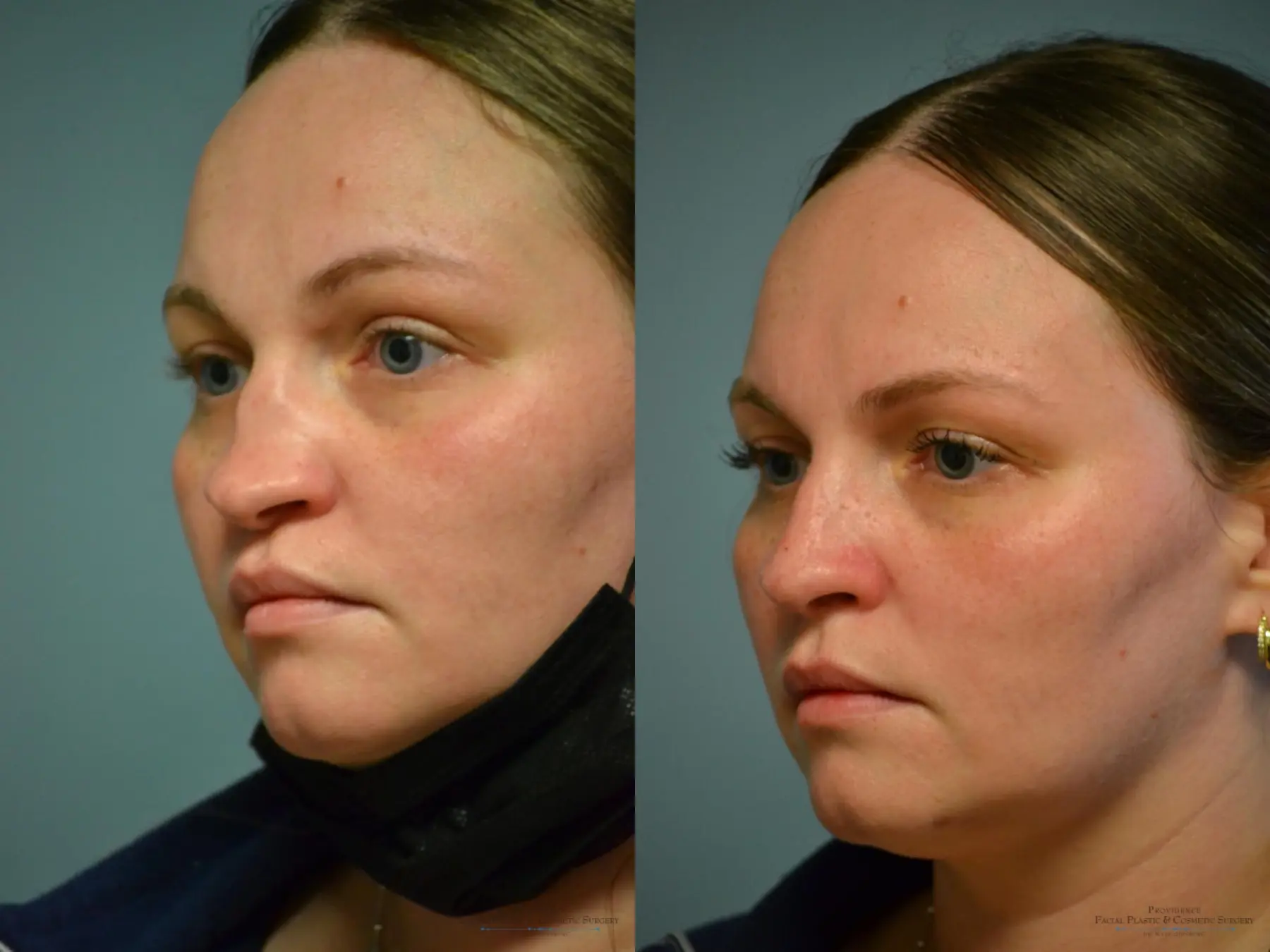 Rhinoplasty: Patient 40 - Before and After 1