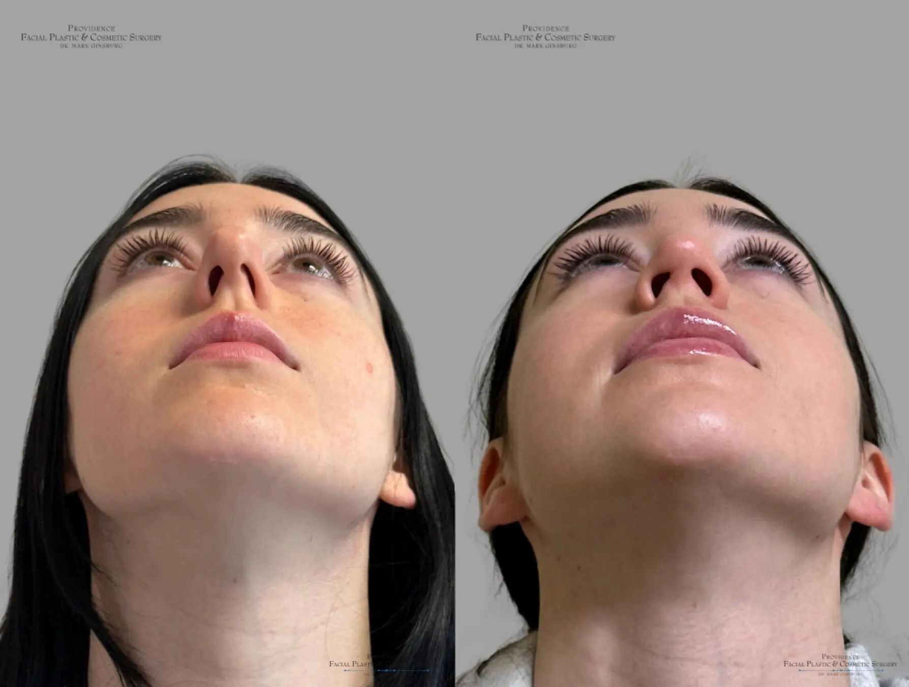 Rhinoplasty: Patient 37 - Before and After 2