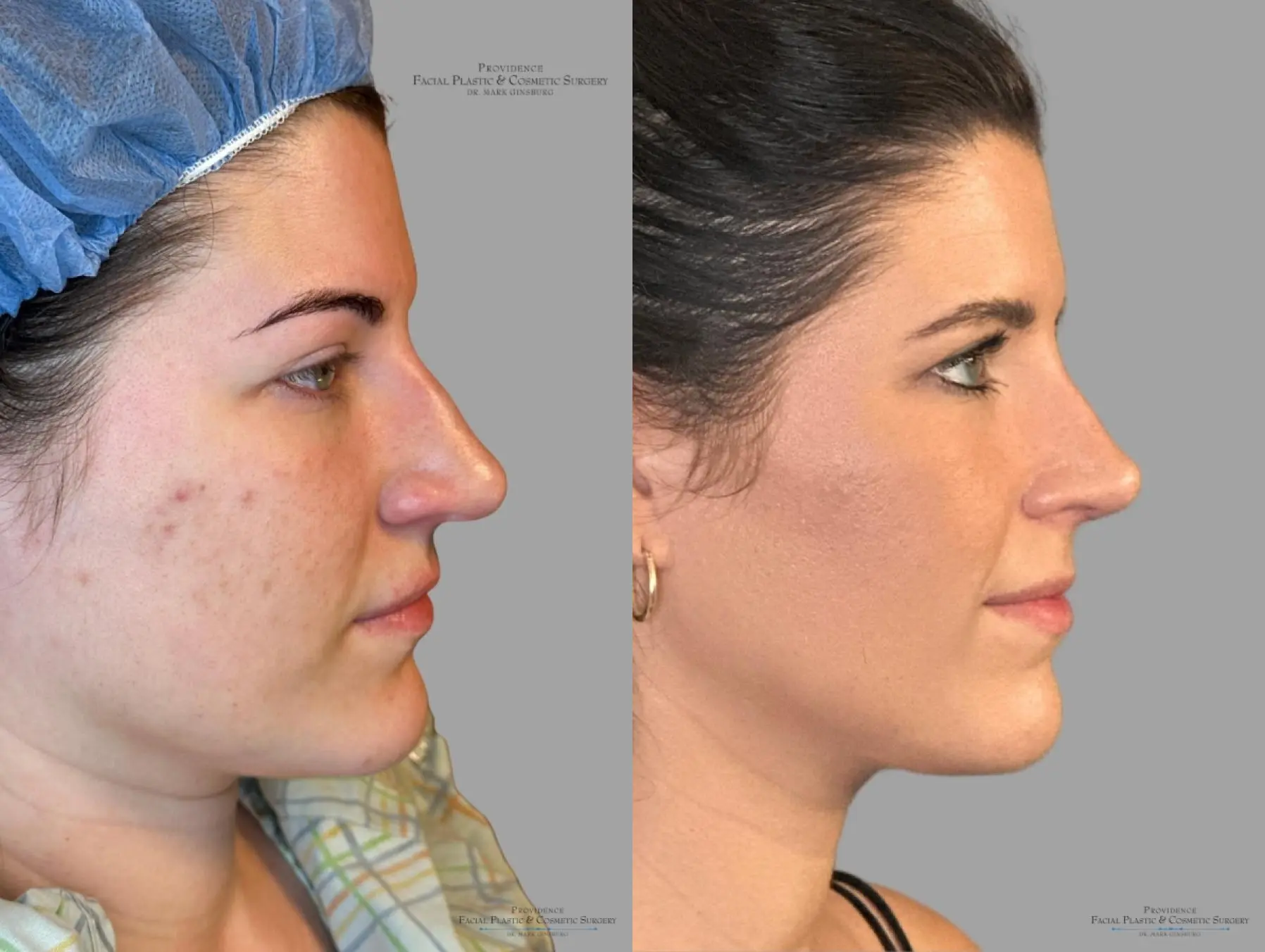 Rhinoplasty: Patient 41 - Before and After 3