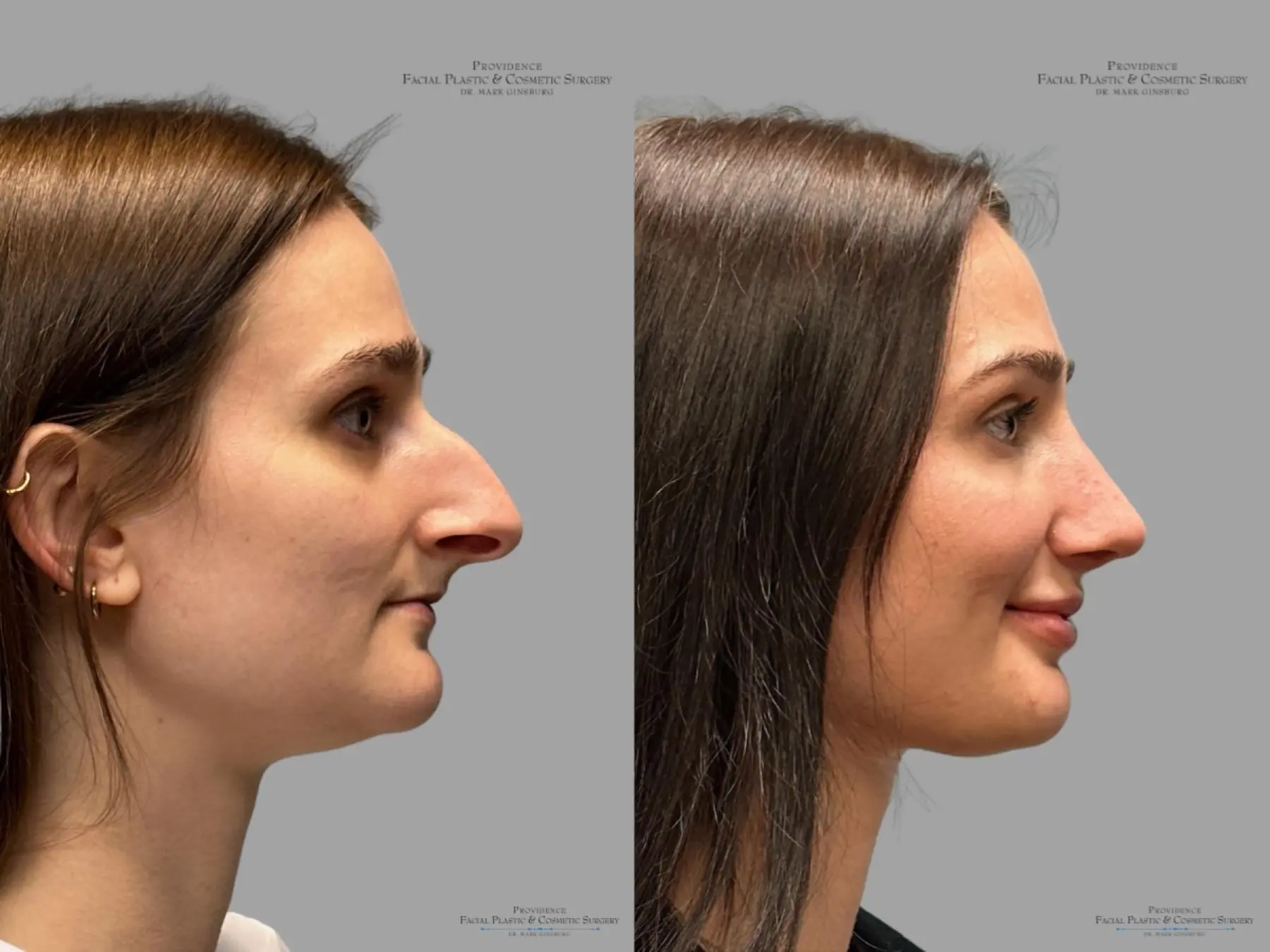 Rhinoplasty: Patient 32 - Before and After 3