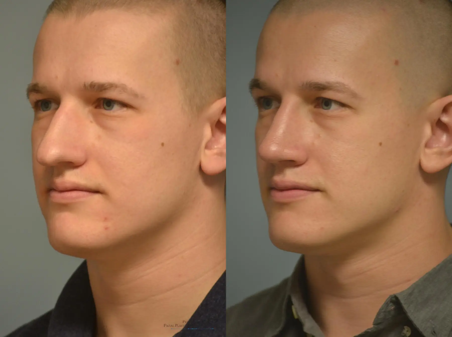 Rhinoplasty: Patient 20 - Before and After 5