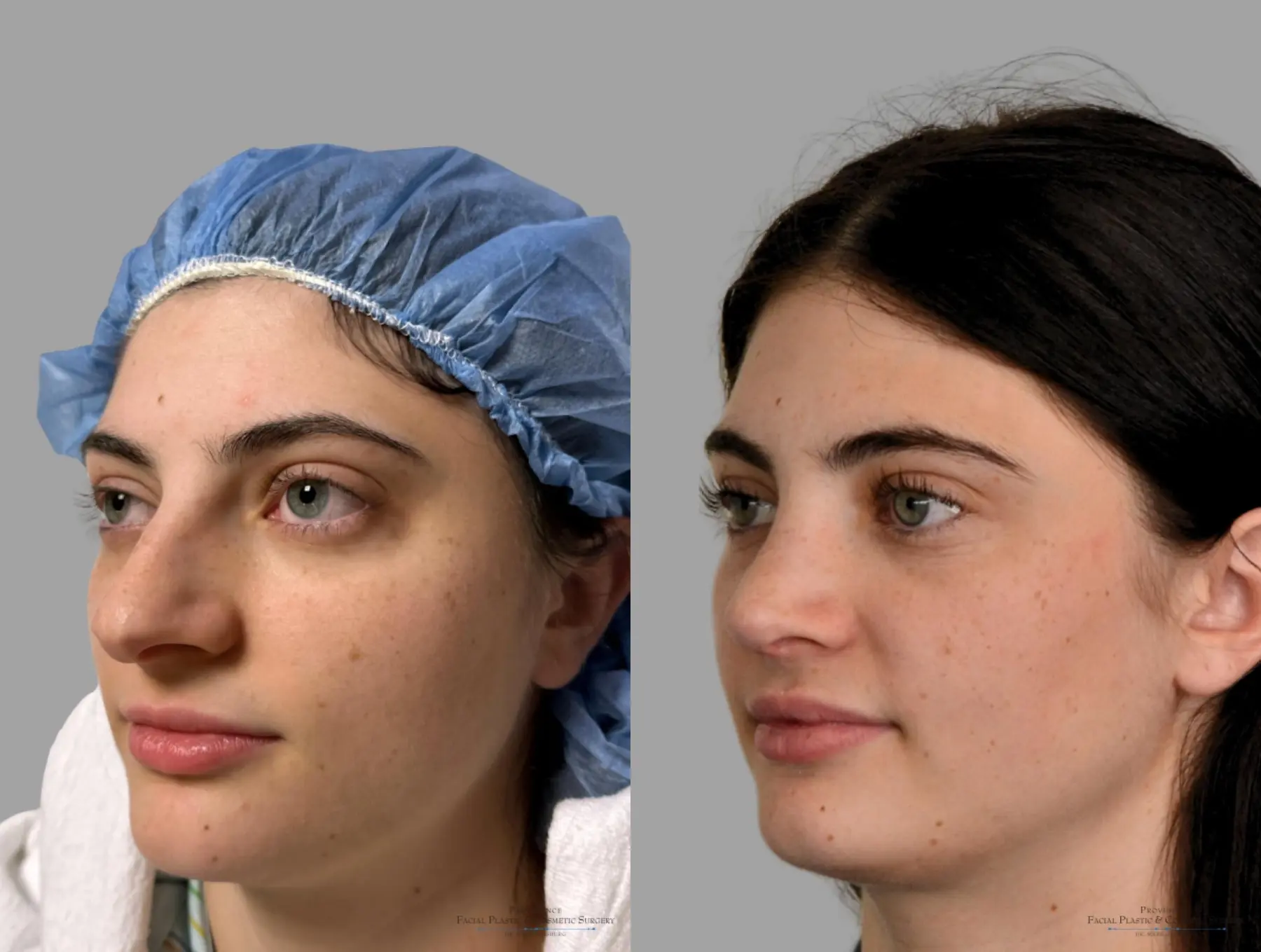 Rhinoplasty: Patient 43 - Before and After 4