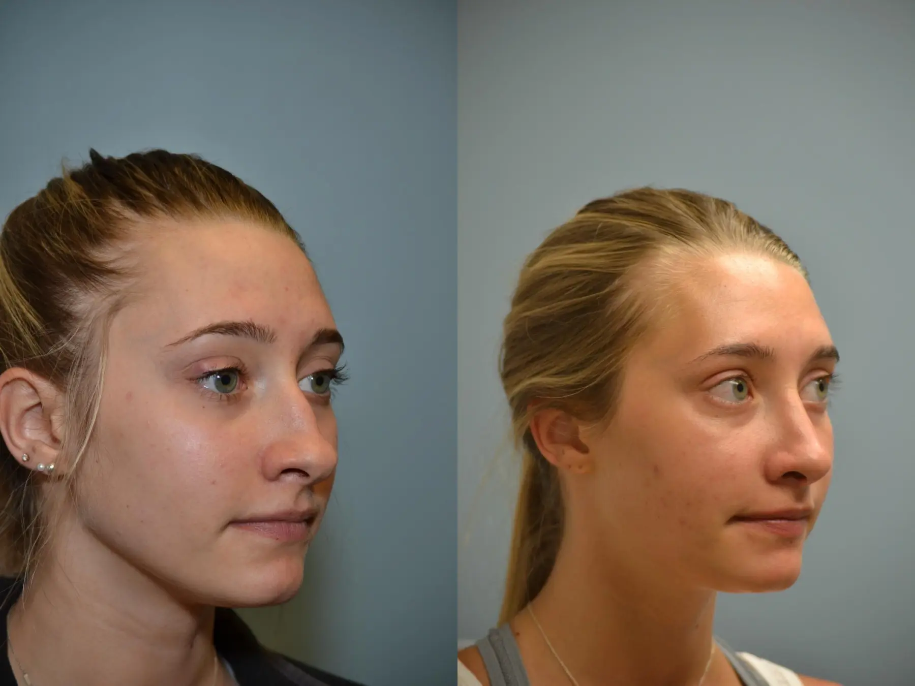 Rhinoplasty: Patient 19 - Before and After 4