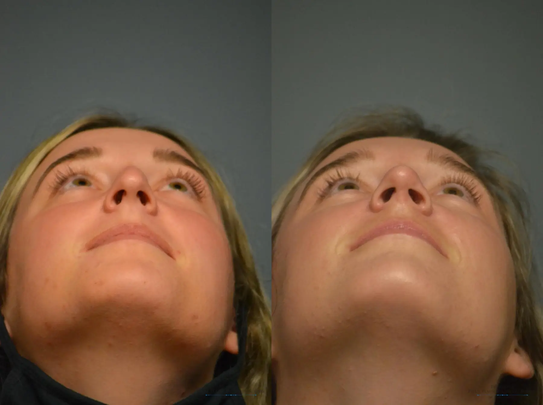 Rhinoplasty: Patient 7 - Before and After 5