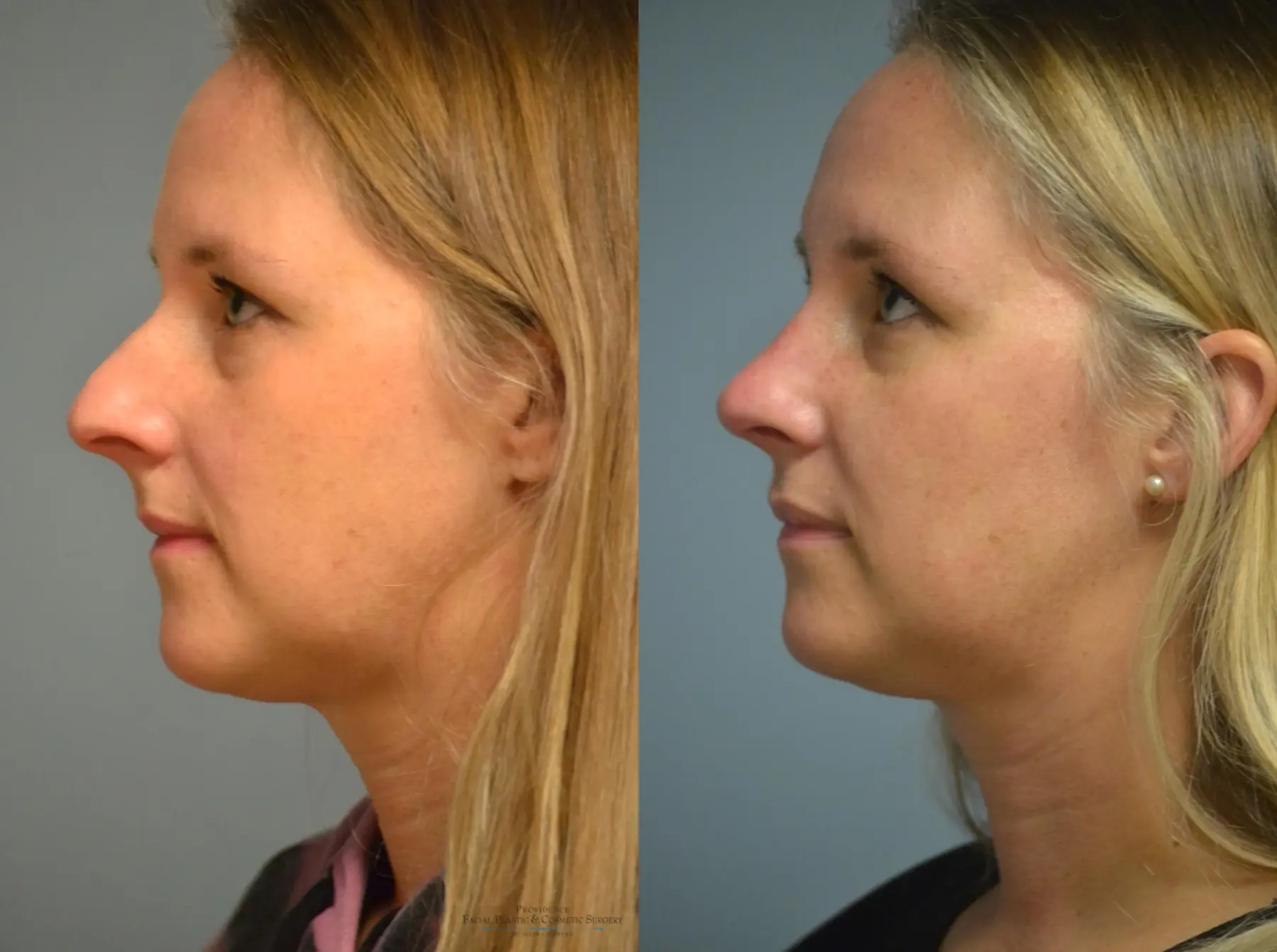 Rhinoplasty: Patient 6 - Before and After 3