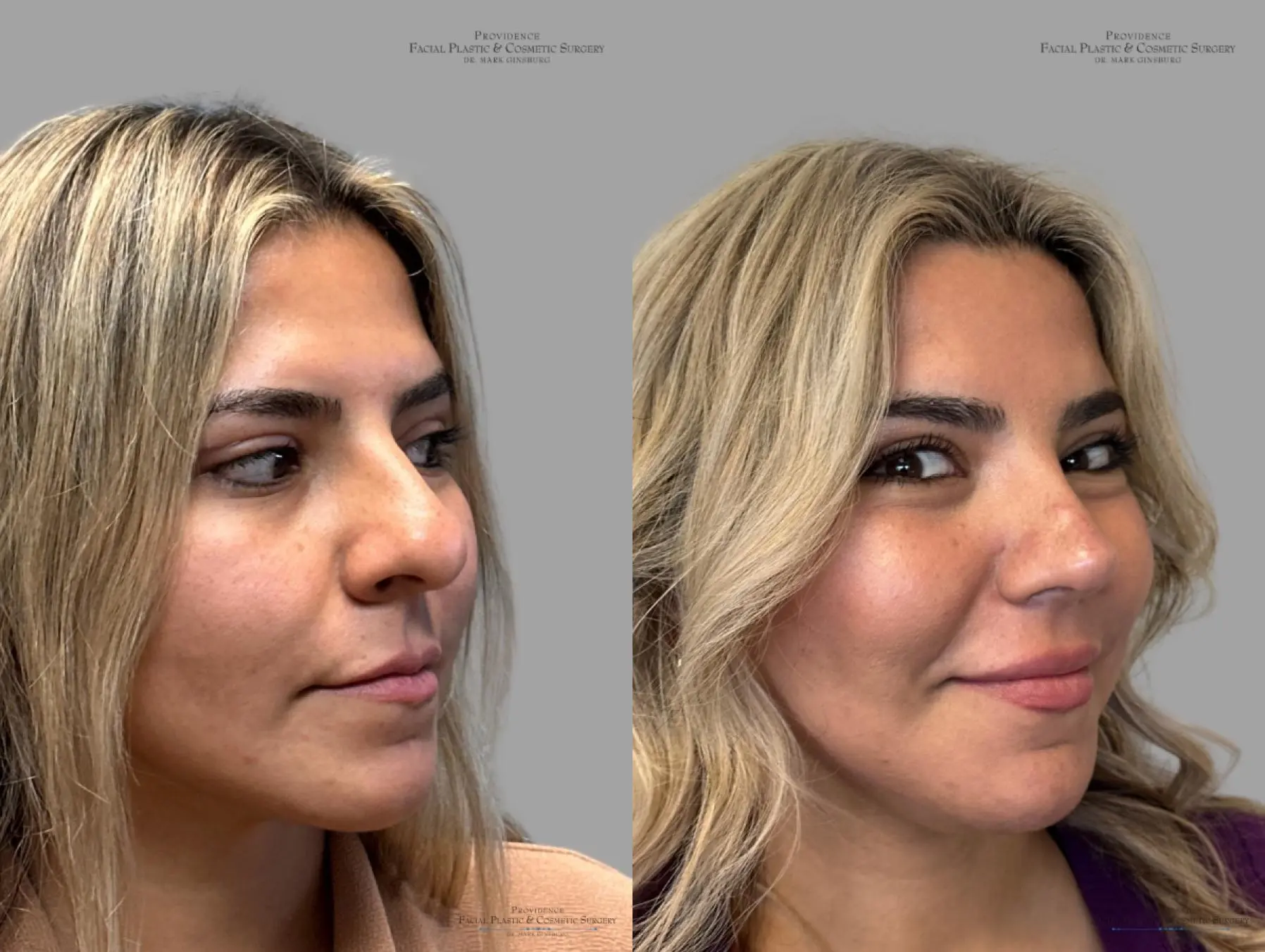 Rhinoplasty: Patient 35 - Before and After 3