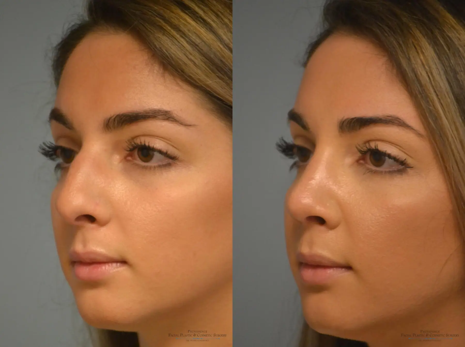 Rhinoplasty: Patient 10 - Before and After 2