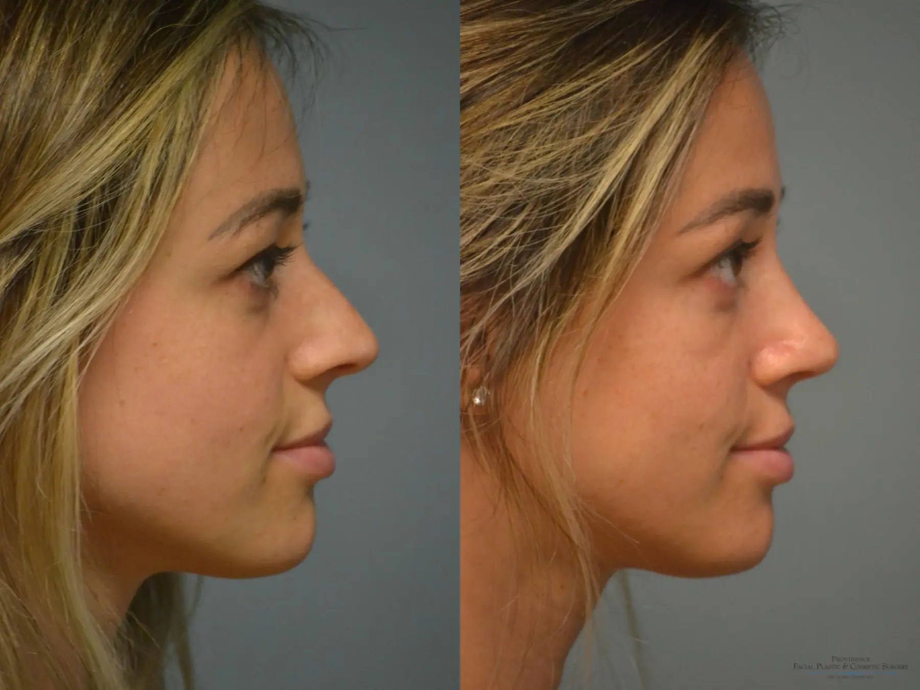 Rhinoplasty: Patient 9 - Before and After 3