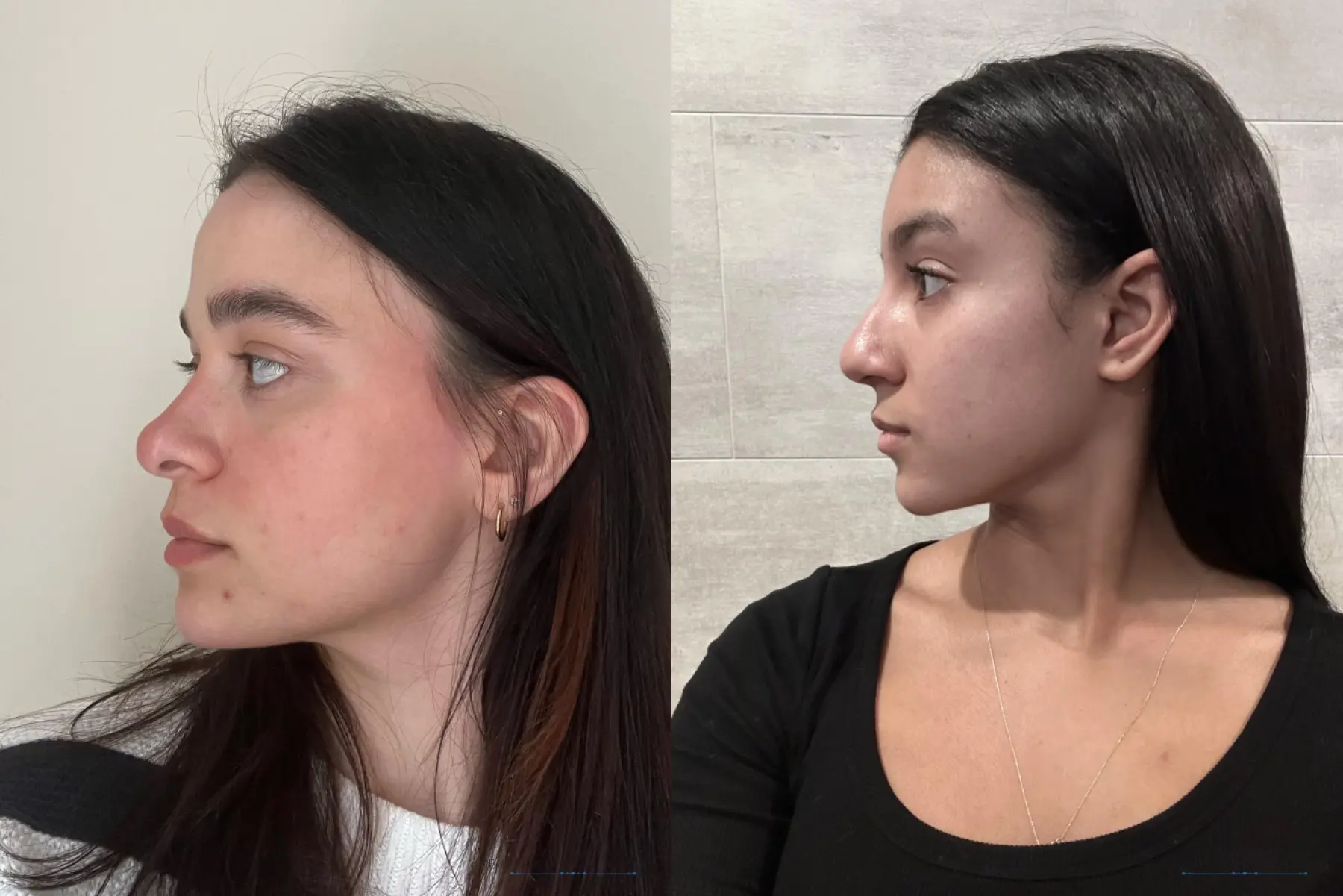Rhinoplasty: Patient 39 - Before and After 2