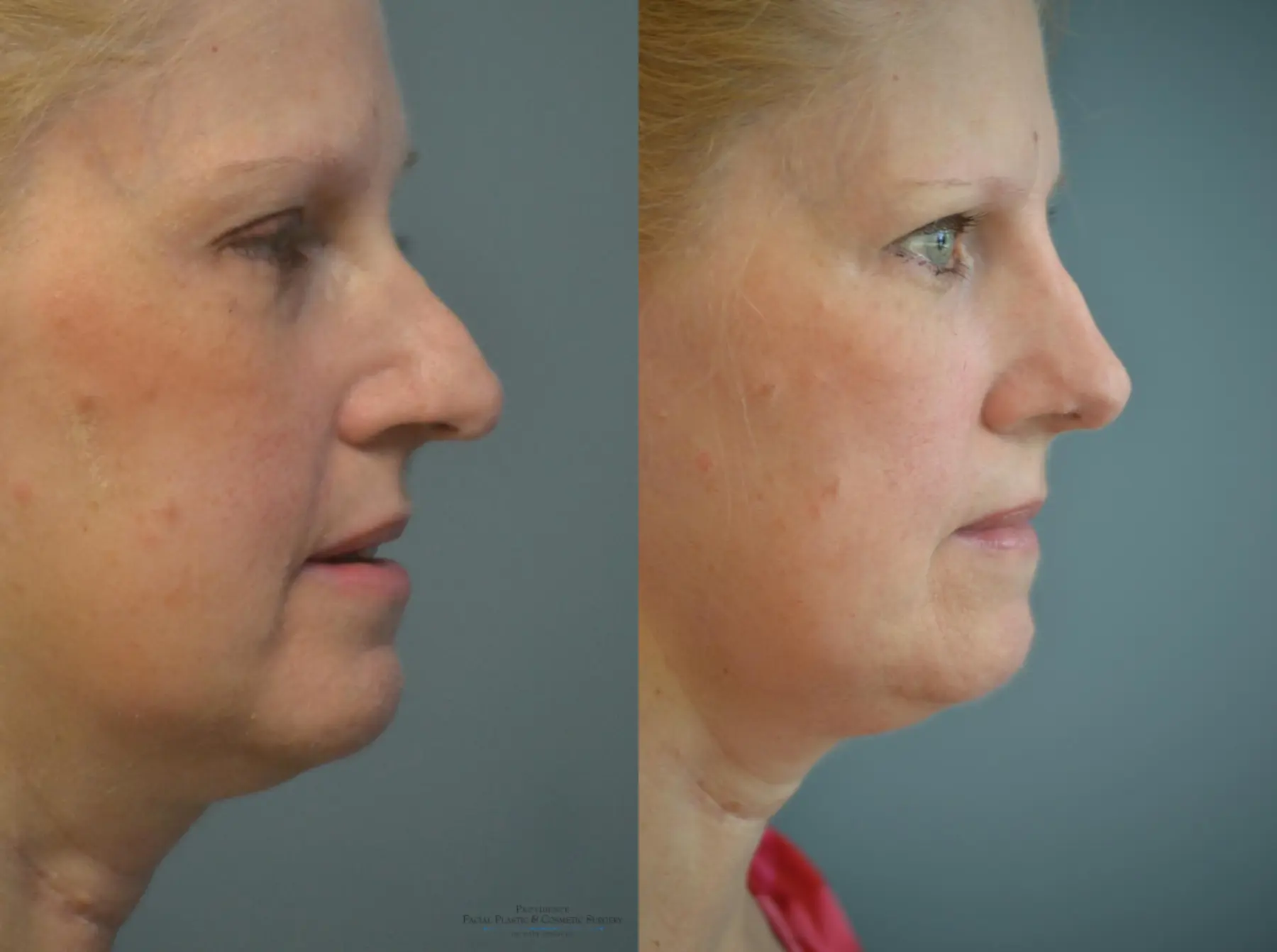 Rhinoplasty: Patient 7 - Before and After 4