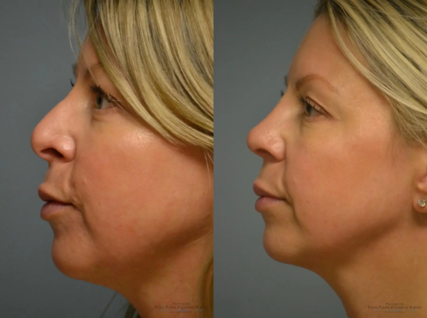 Rhinoplasty: Patient 4 - Before and After 2