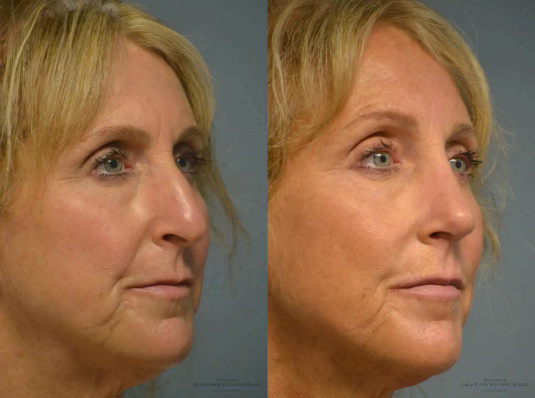 Rhinoplasty: Patient 14 - Before and After 4