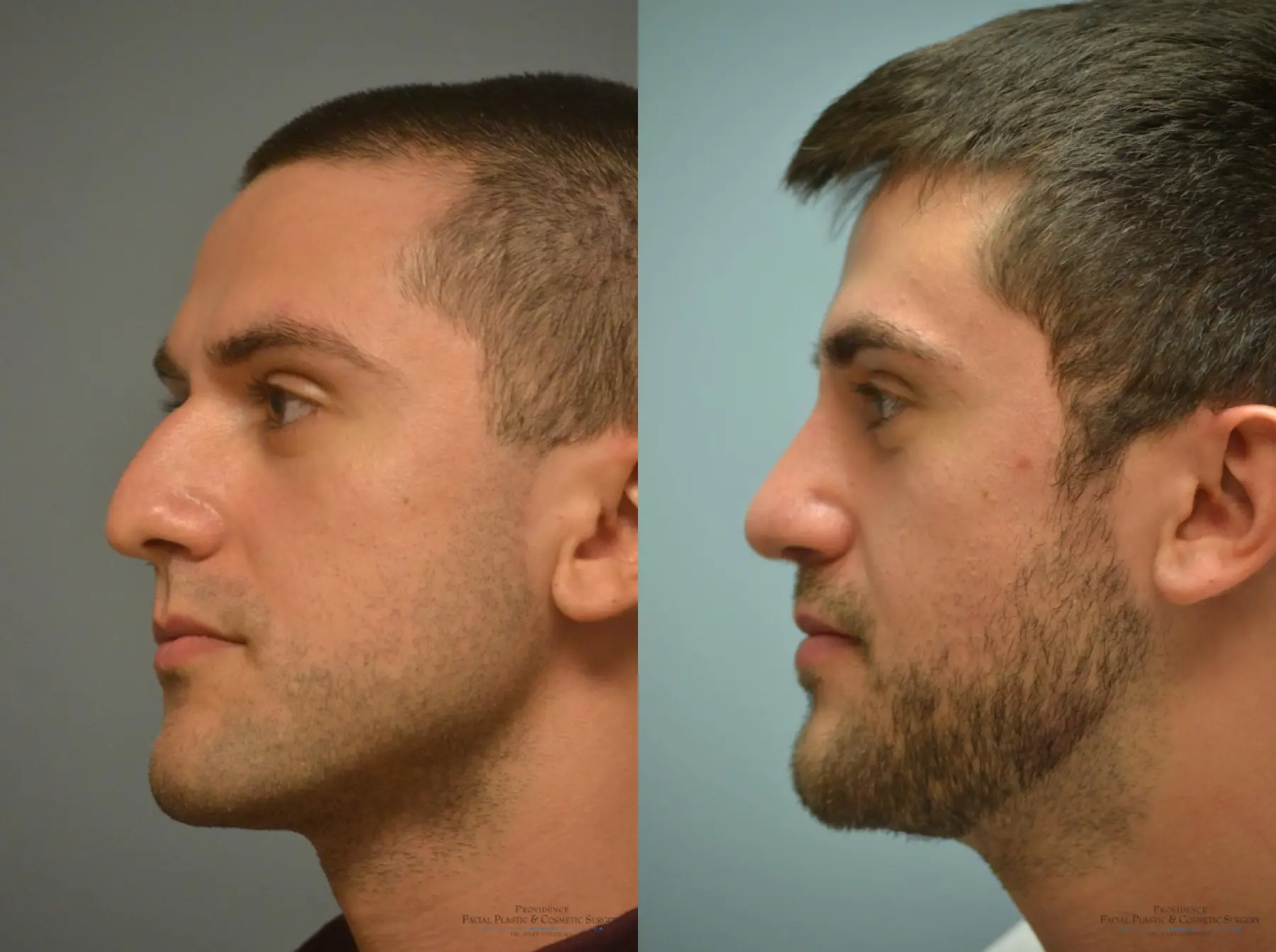 Rhinoplasty: Patient 2 - Before and After 3