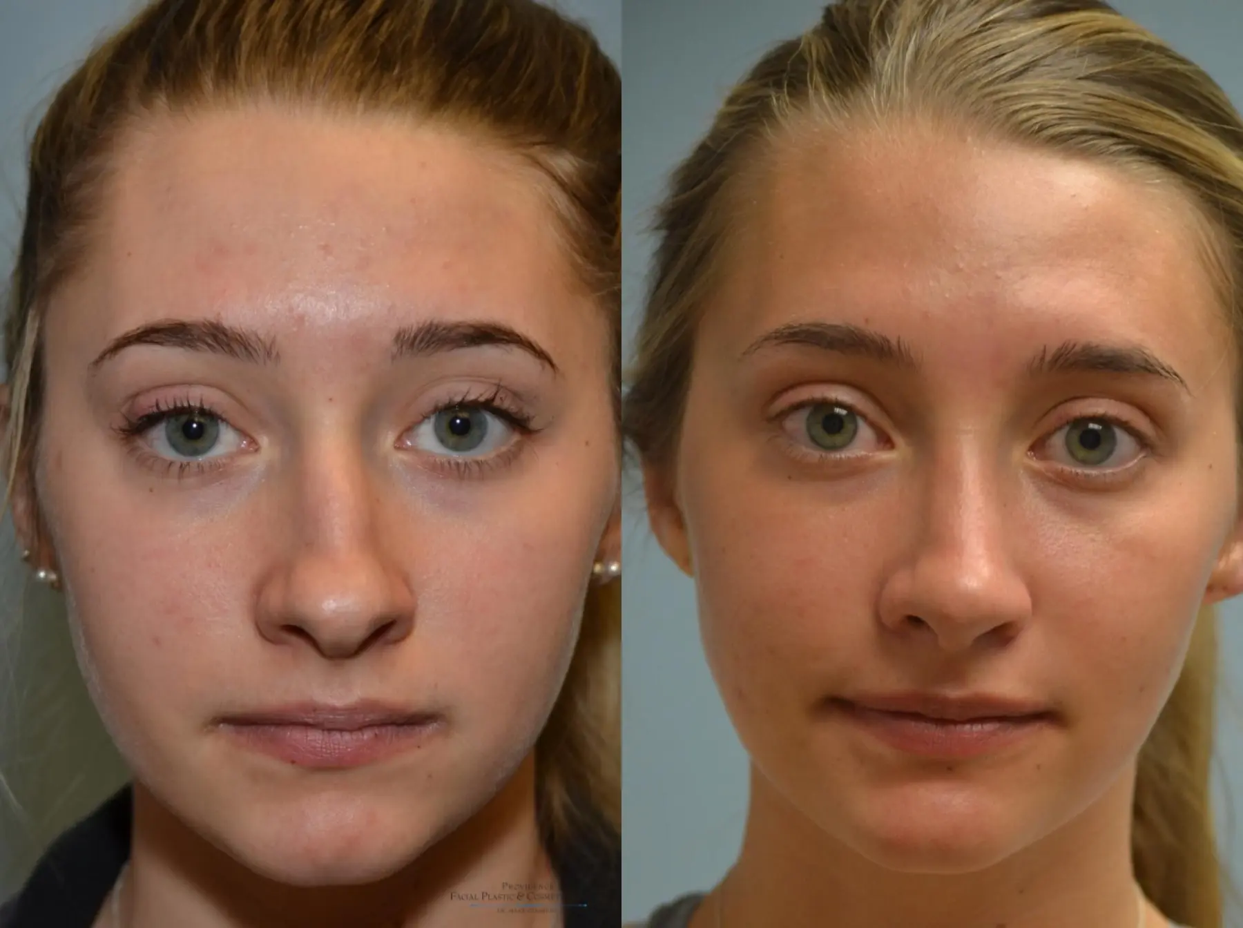 Rhinoplasty: Patient 19 - Before and After 1