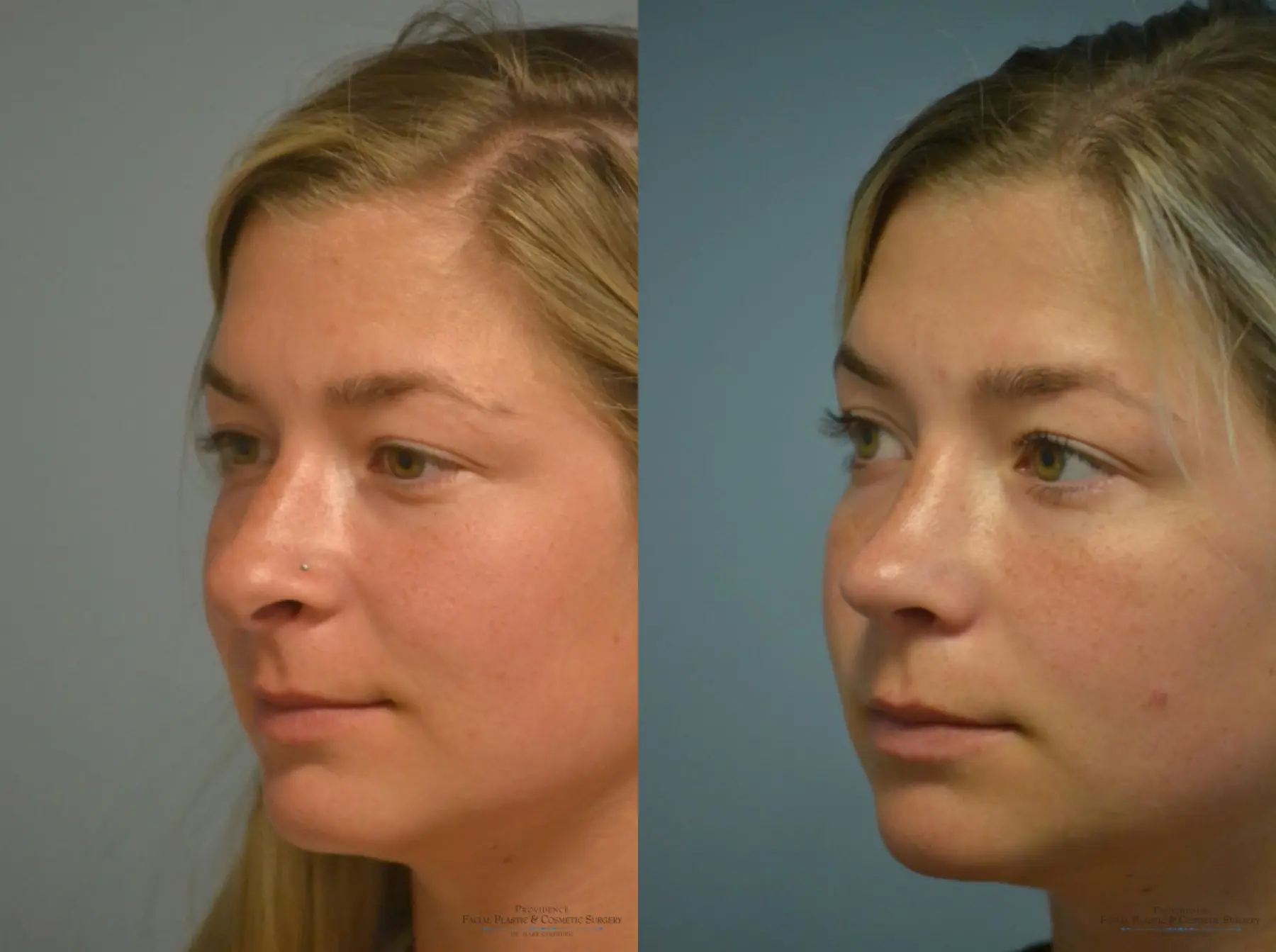 Rhinoplasty: Patient 5 - Before and After 2