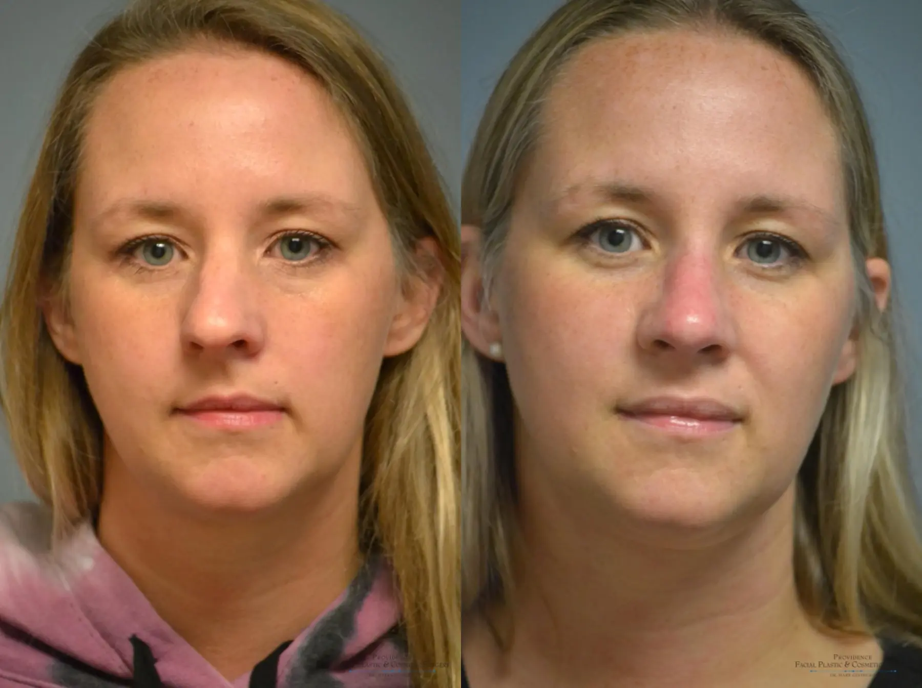 Rhinoplasty: Patient 6 - Before and After  