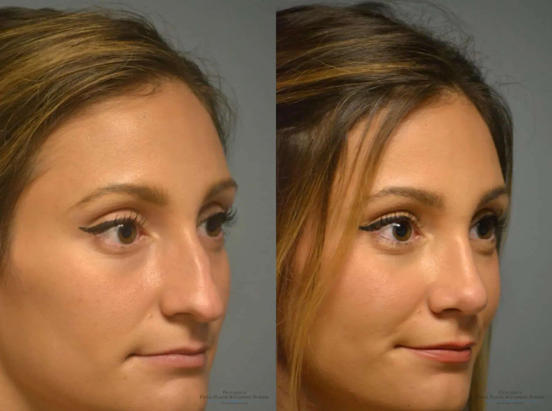 Rhinoplasty: Patient 1 - Before and After 4