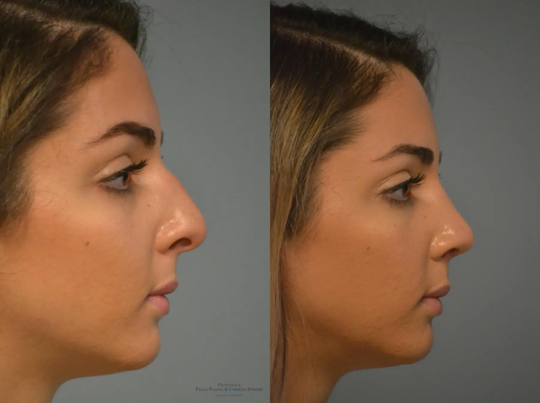 Rhinoplasty: Patient 10 - Before and After 4