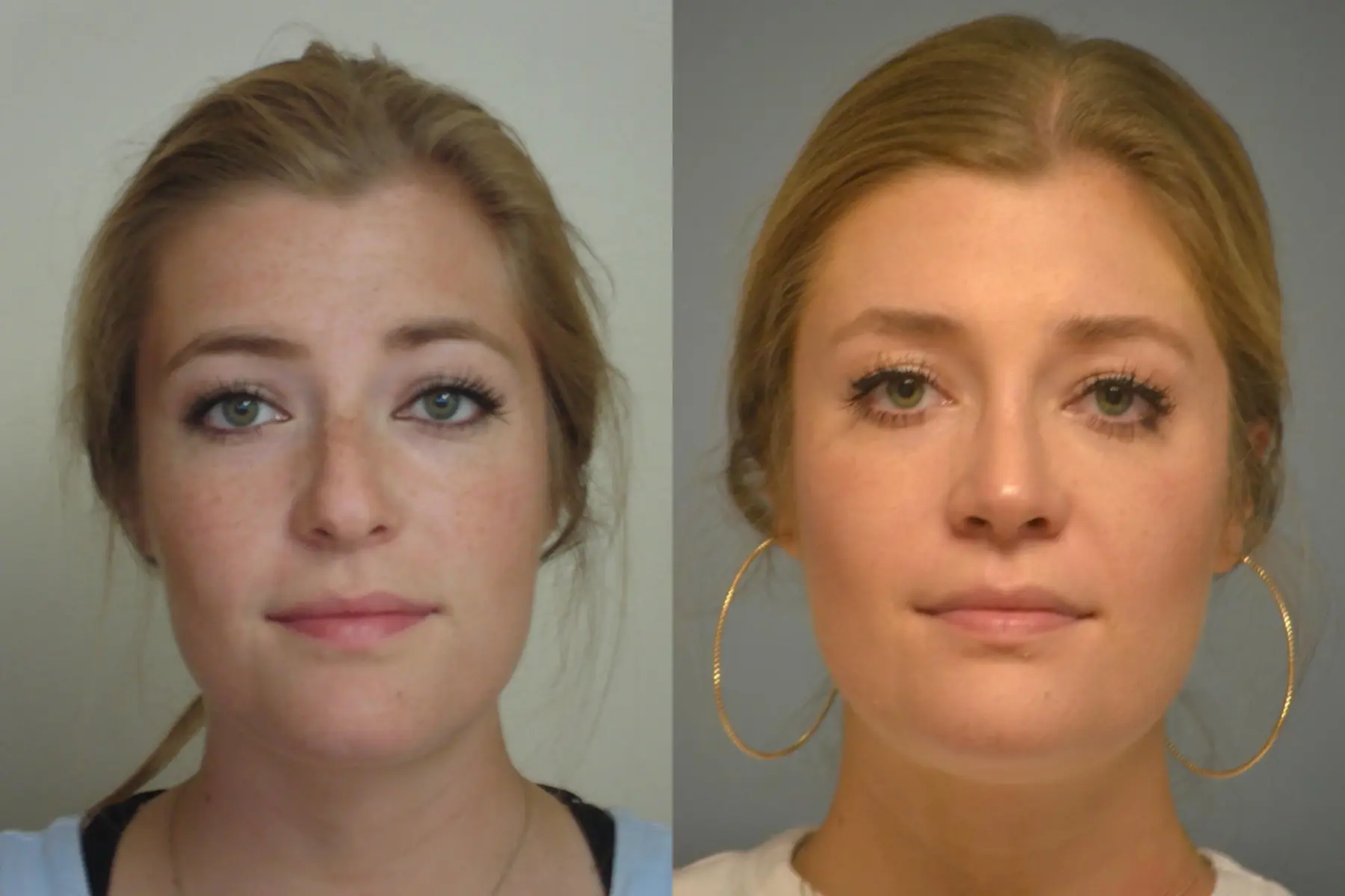 Rhinoplasty: Patient 25 - Before and After 1