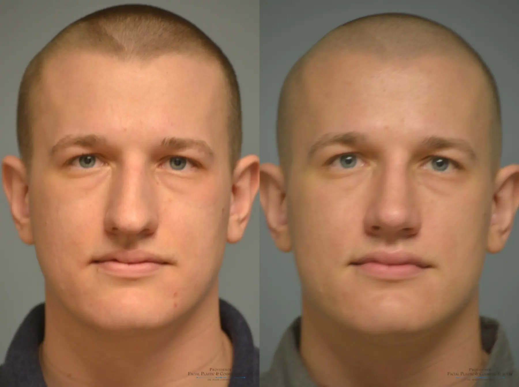 Rhinoplasty: Patient 20 - Before and After 1