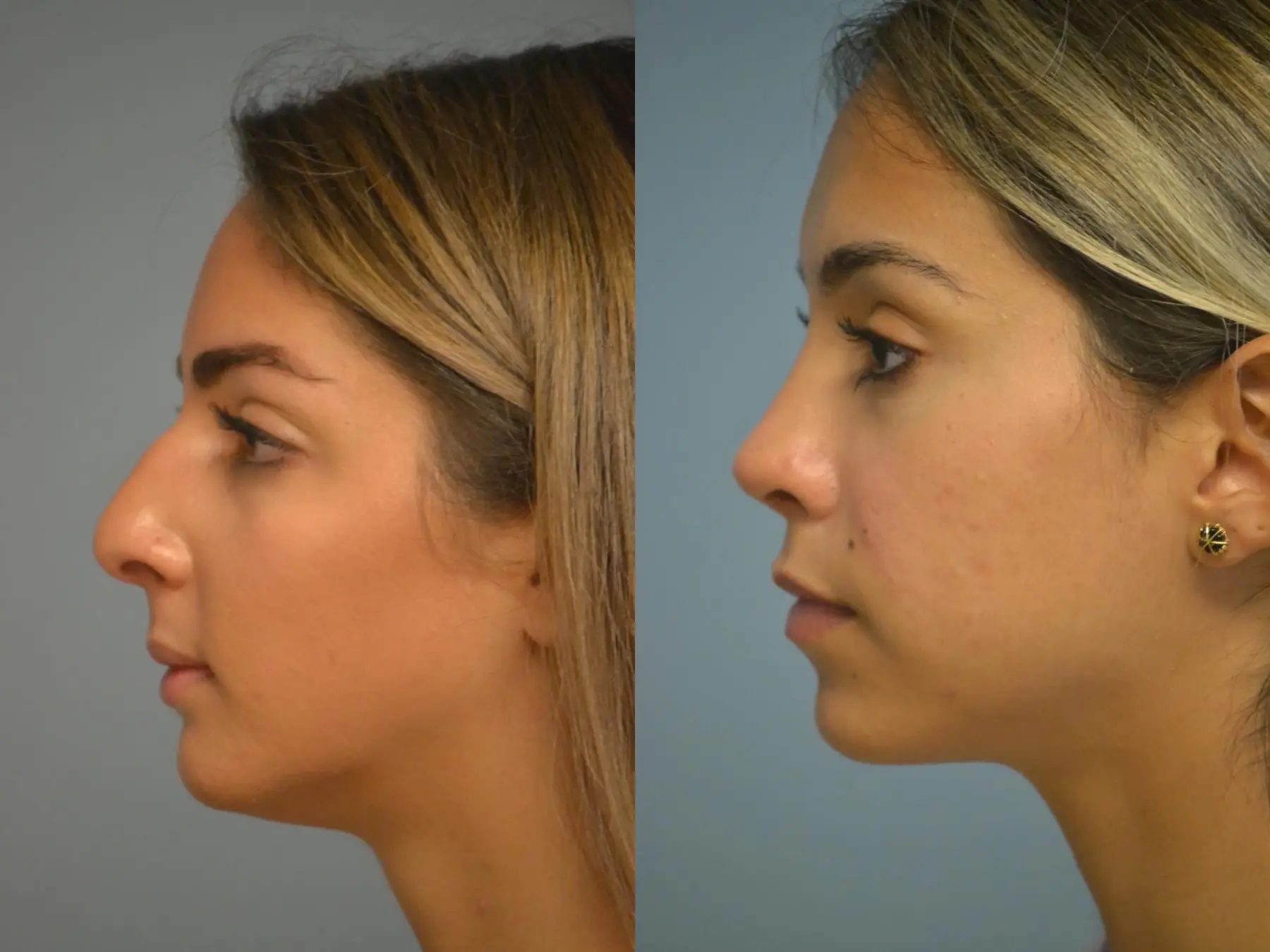Rhinoplasty: Patient 24 - Before and After 3