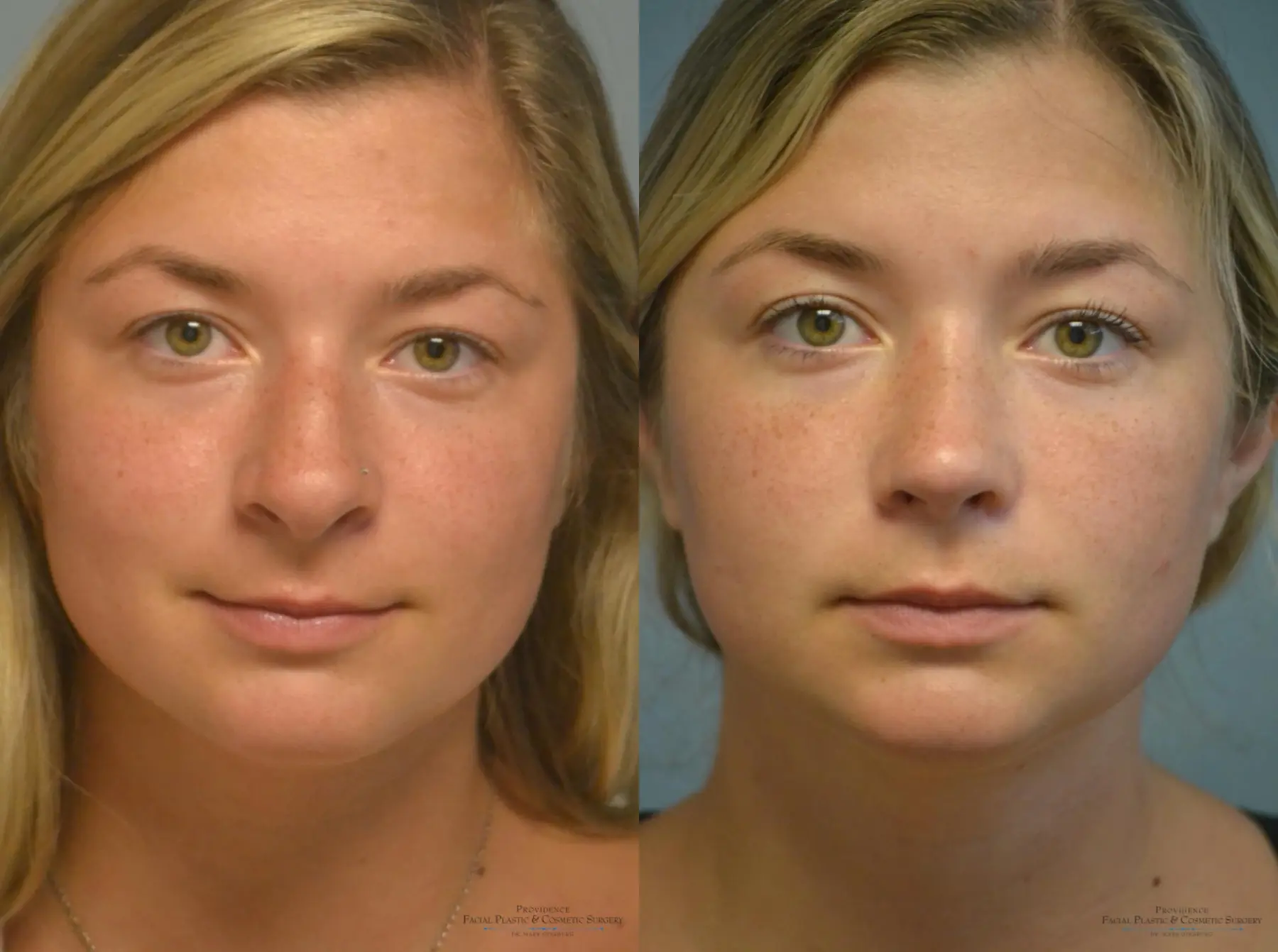 Rhinoplasty: Patient 5 - Before and After 1